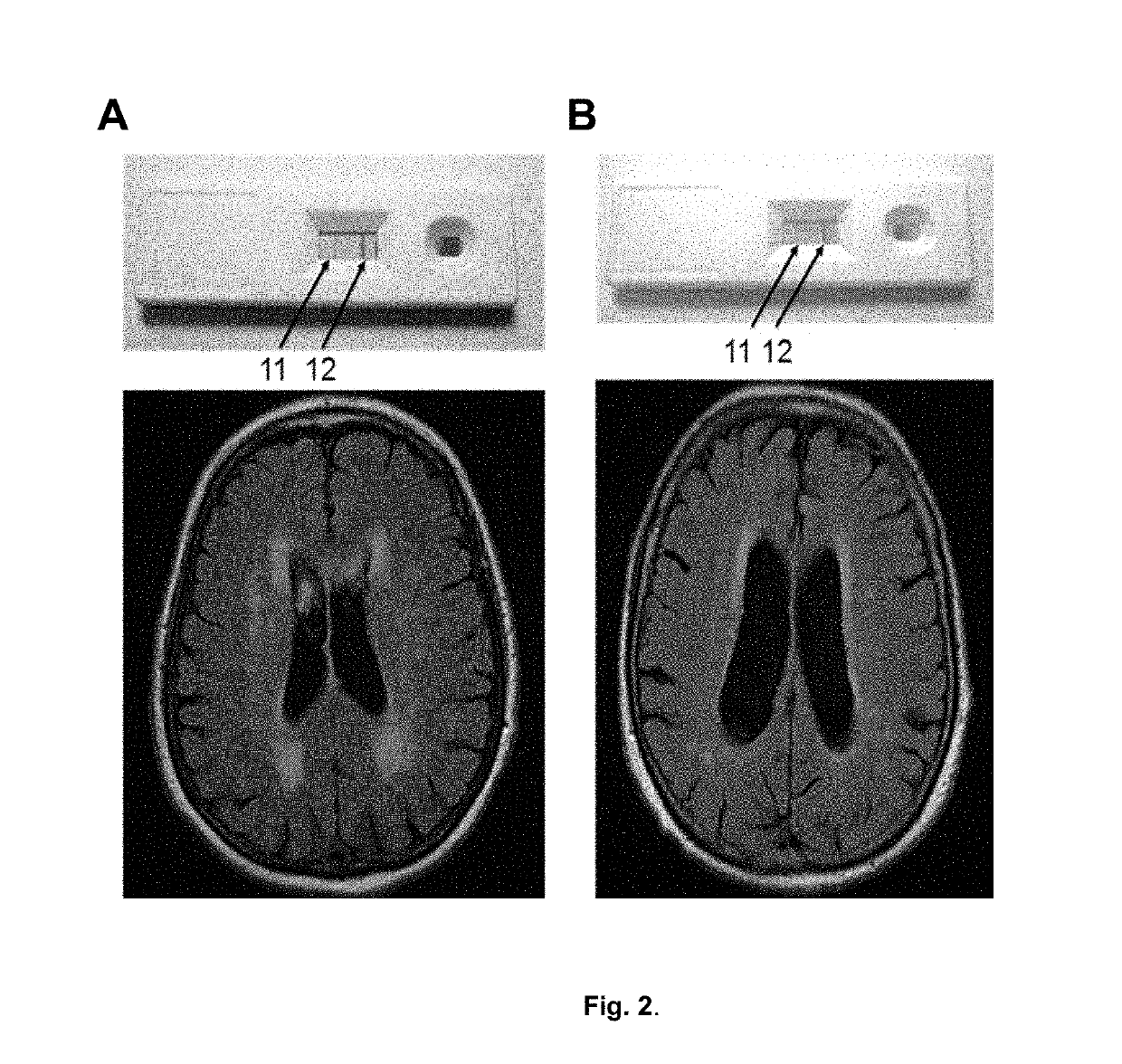 Diagnostic reagent kit for detecting chronic brain pathologies of ischemic genesis