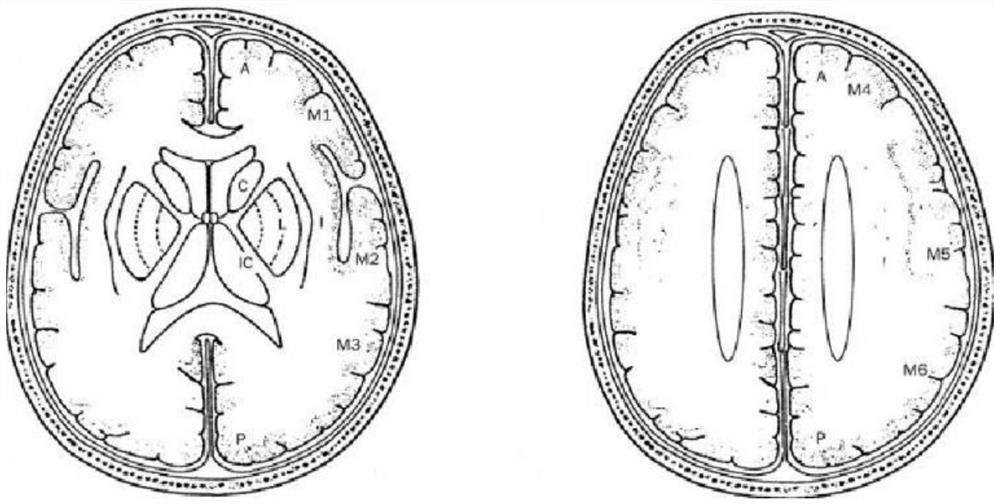 Method for auxiliary diagnosis of acute ischemic stroke based on CT flat scanning images