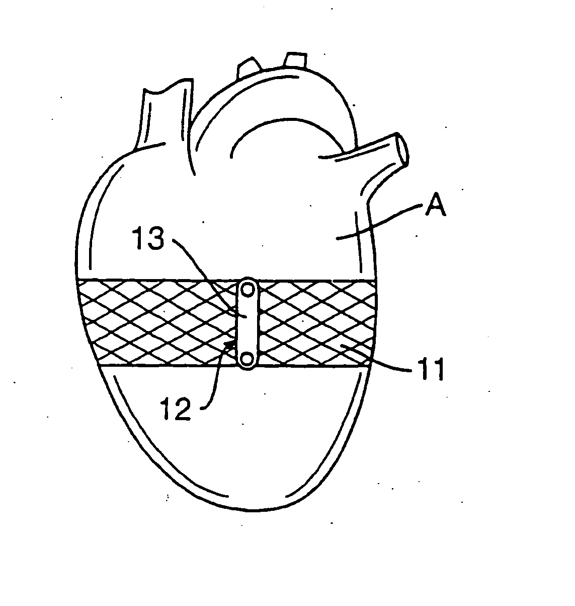 Heart wall tension reduction apparatus and method