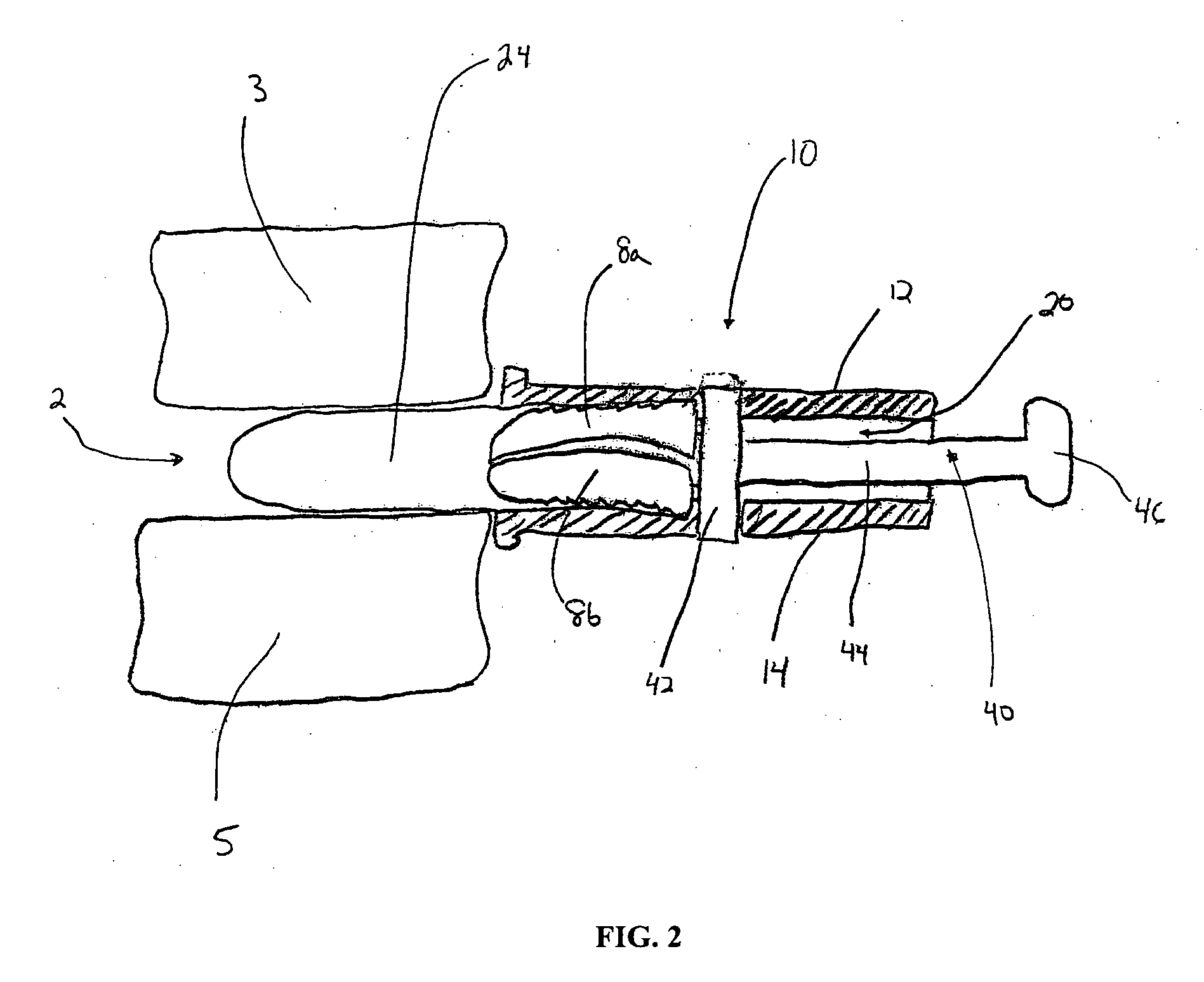 Insertion guide for a spinal implant