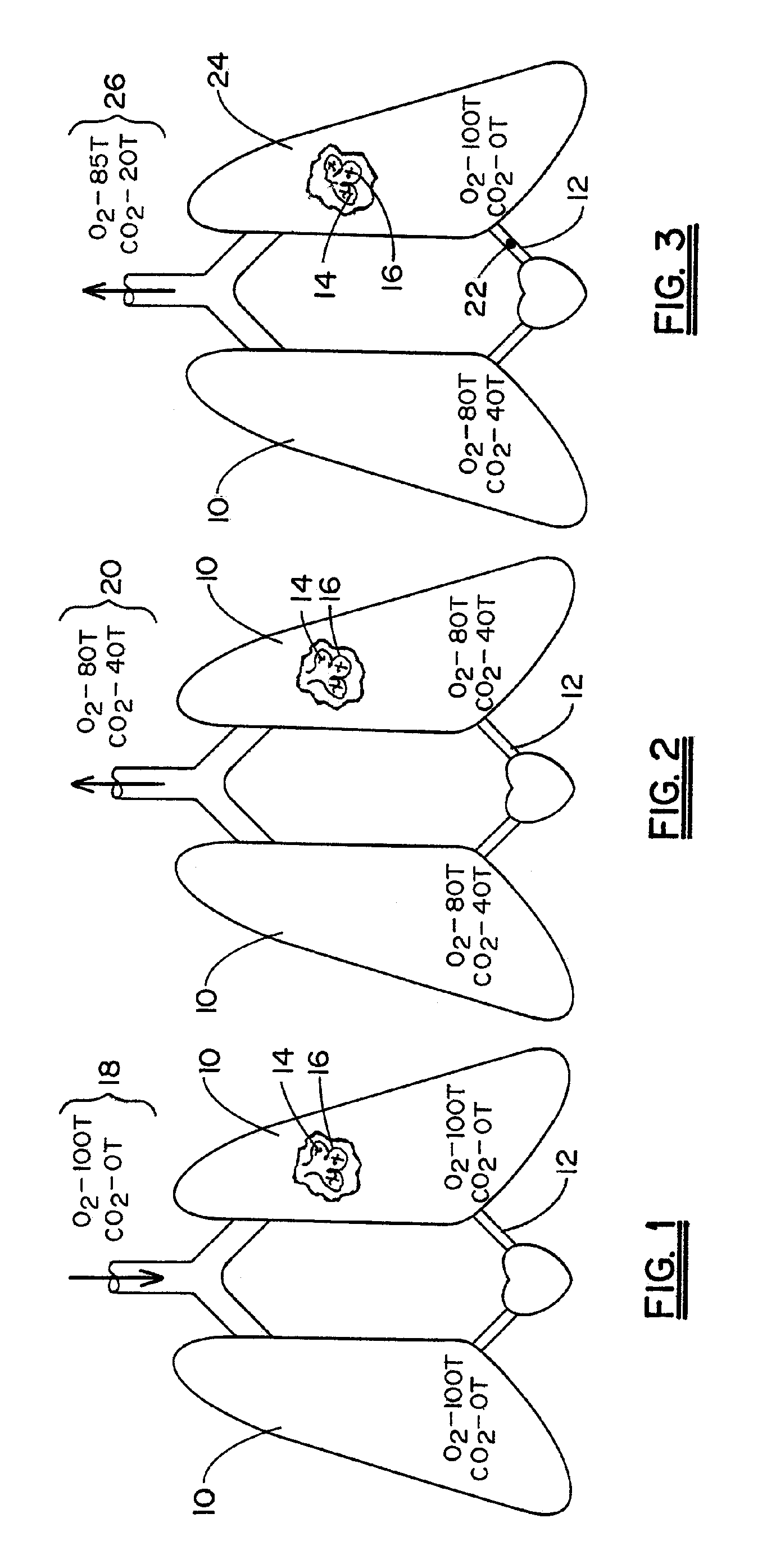 Non-invasive device and method for the diagnosis of pulmonary vascular occlusions