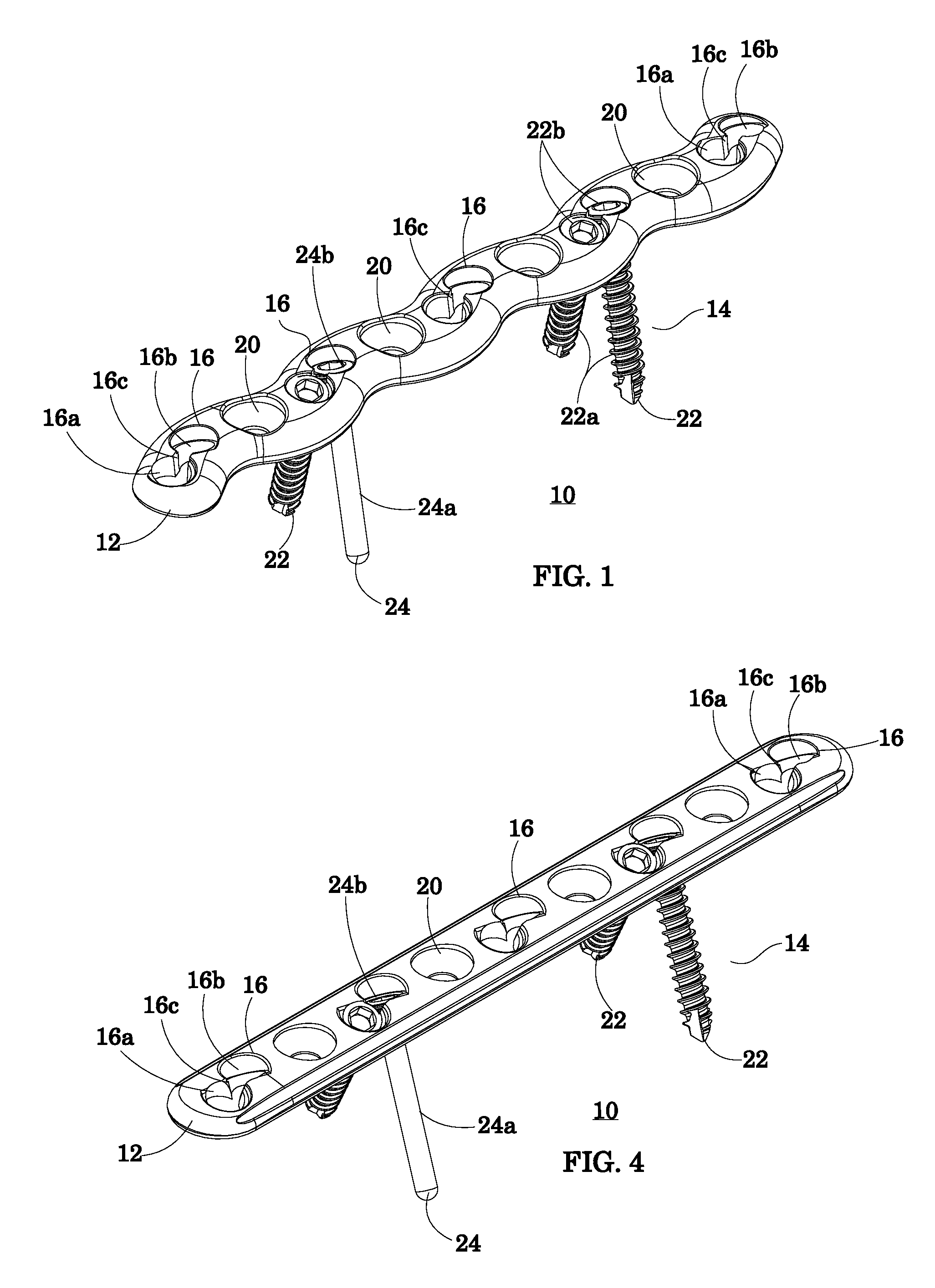 Bone fixation system and method