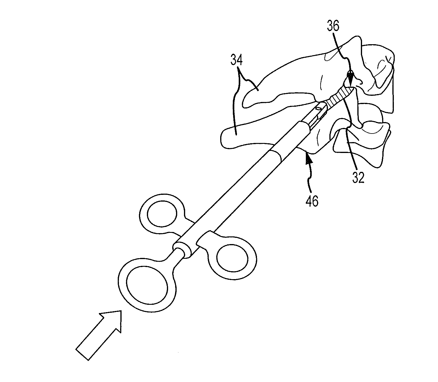 Cervical distraction/implant delivery device