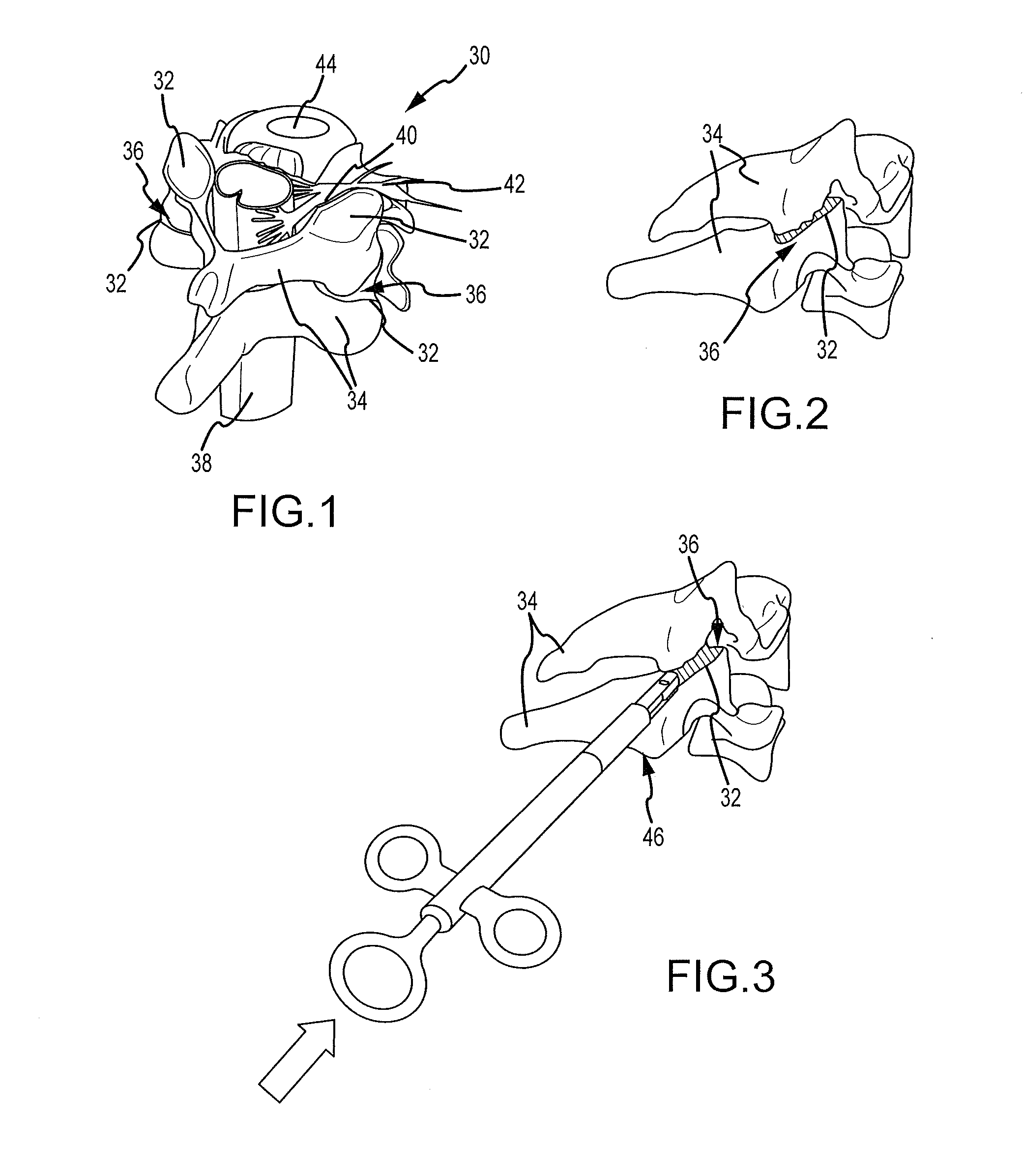 Cervical distraction/implant delivery device