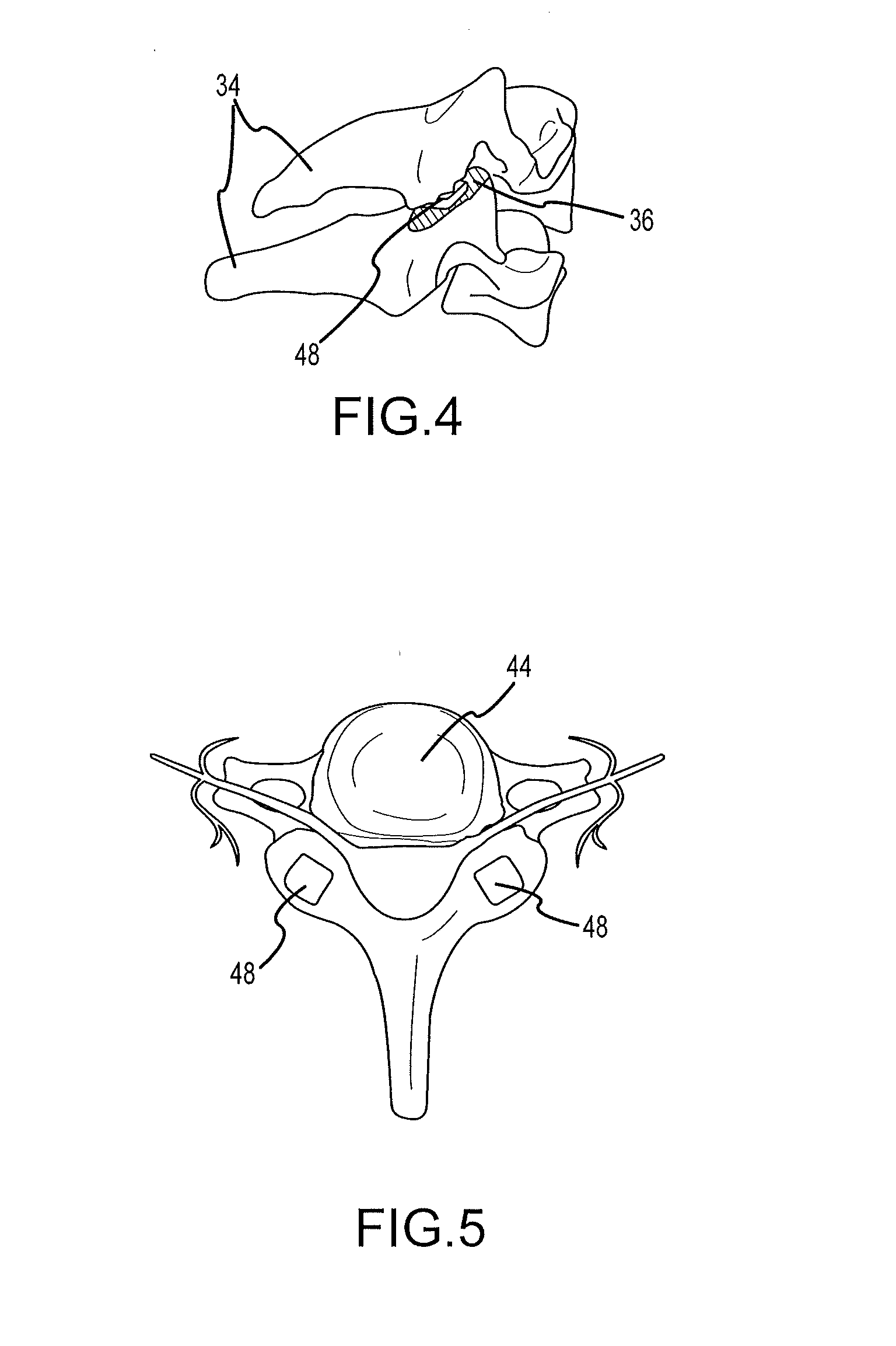 Cervical distraction/implant delivery device