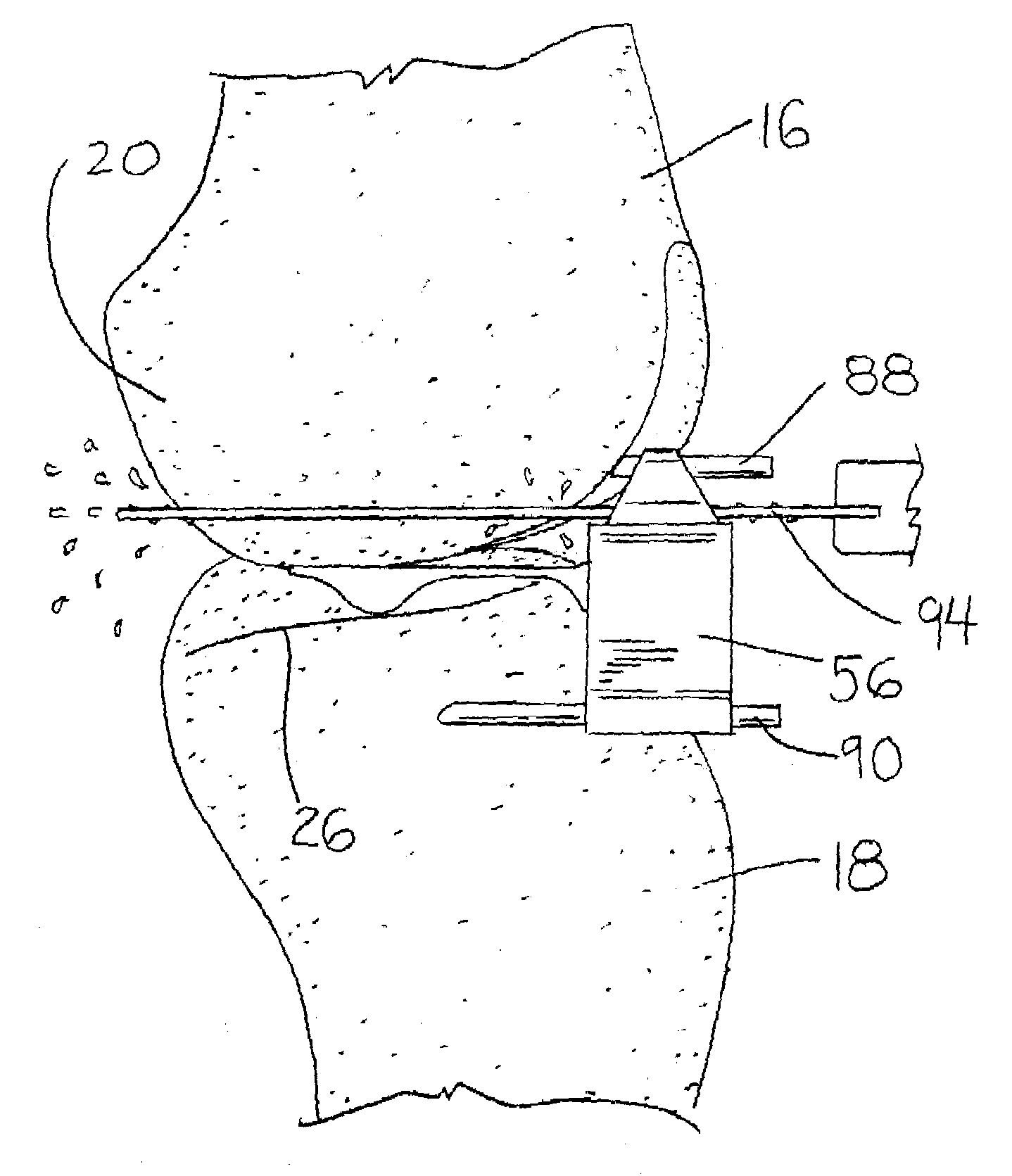 Method and apparatus for resecting a distal femur and a proximal tibia in preparation for implementing a partial knee prosthesis