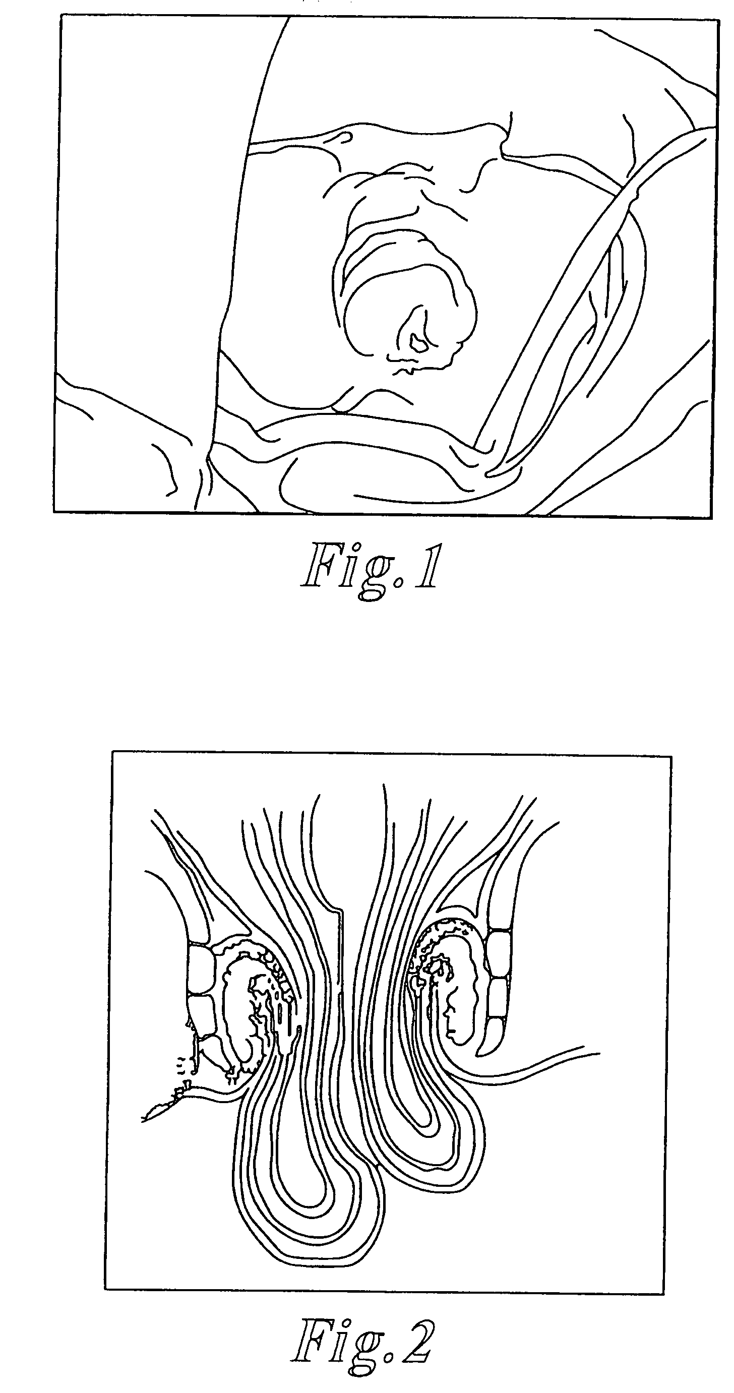 Methods and articles for treatment of rectal prolapse