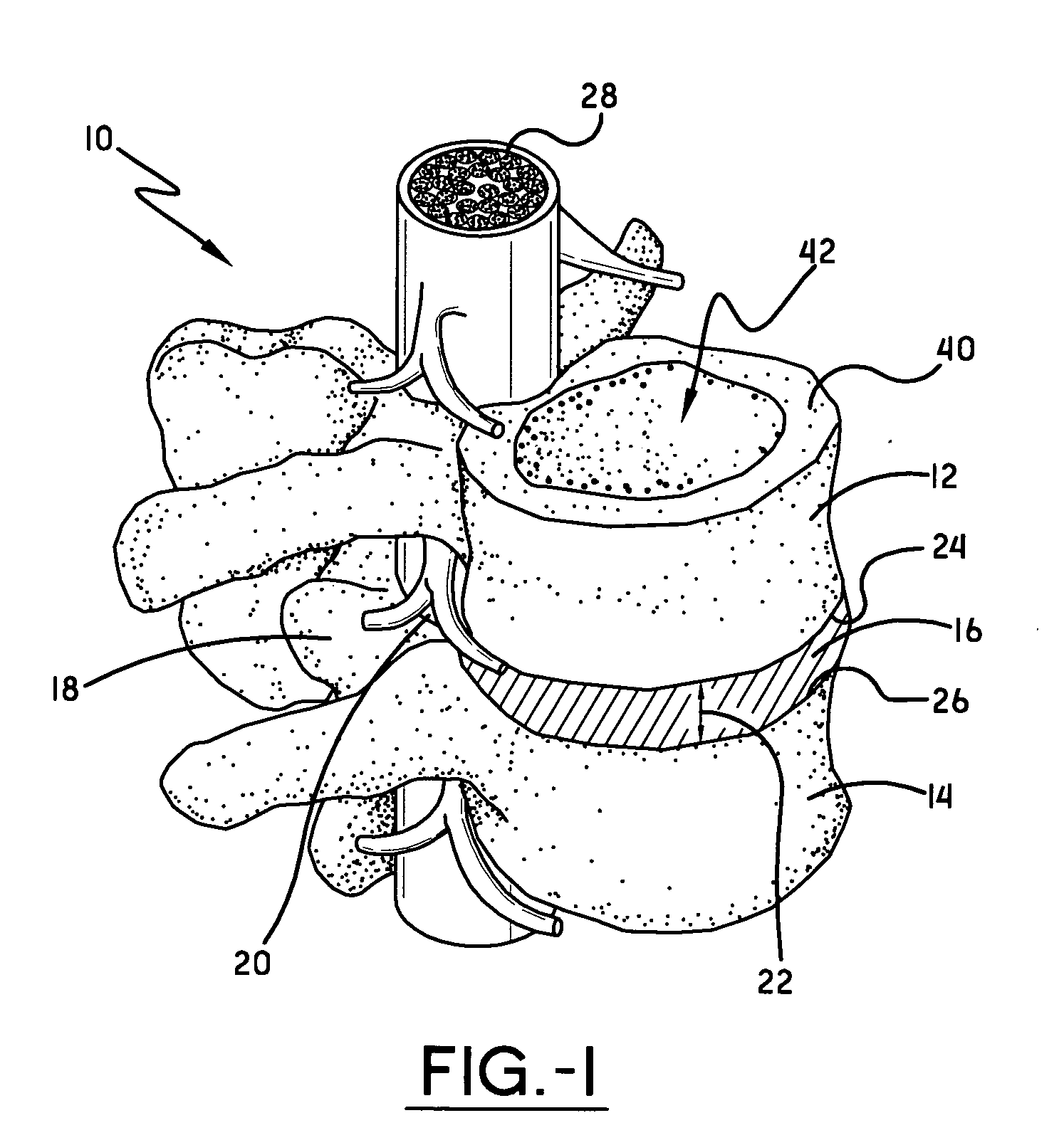 Spine surgery method and motion preserving implant