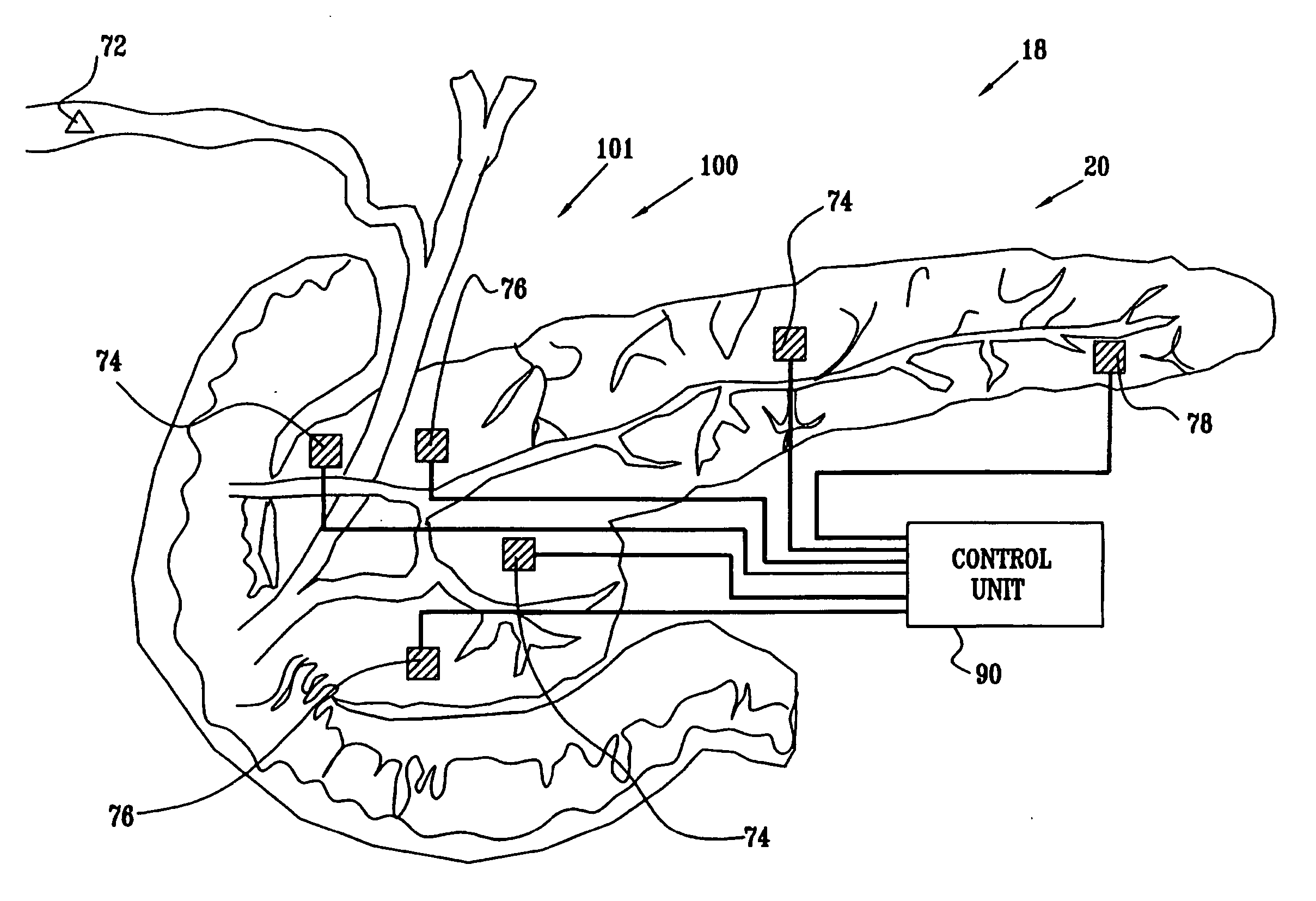 Sensing of pancreatic electrical activity