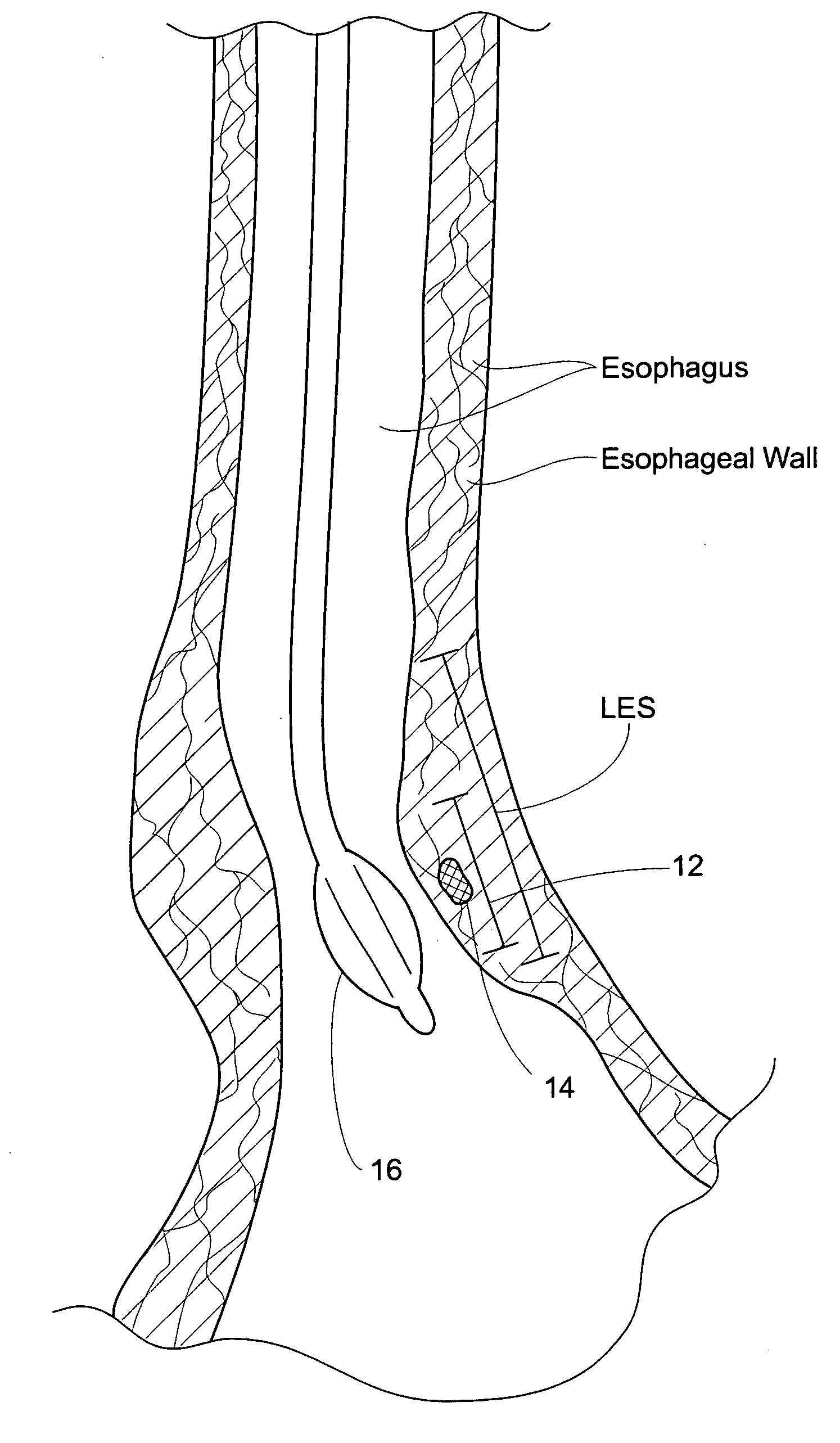 GERD treatment apparatus and method