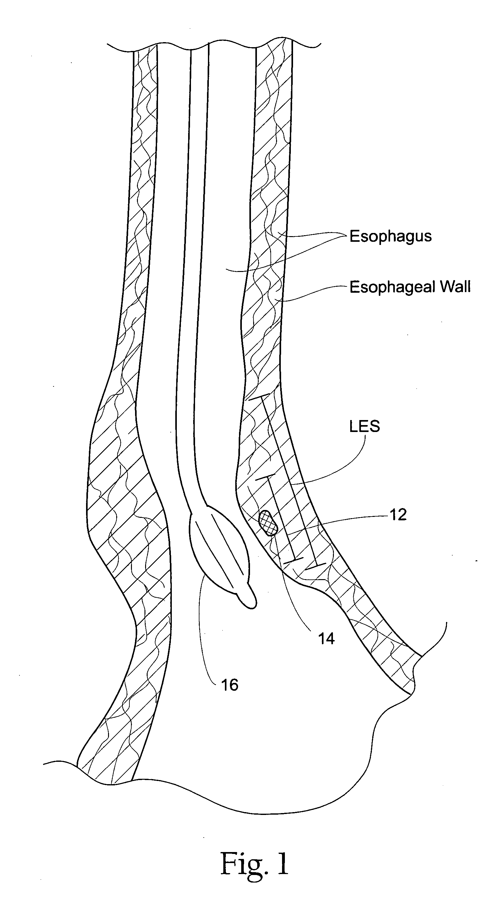 GERD treatment apparatus and method