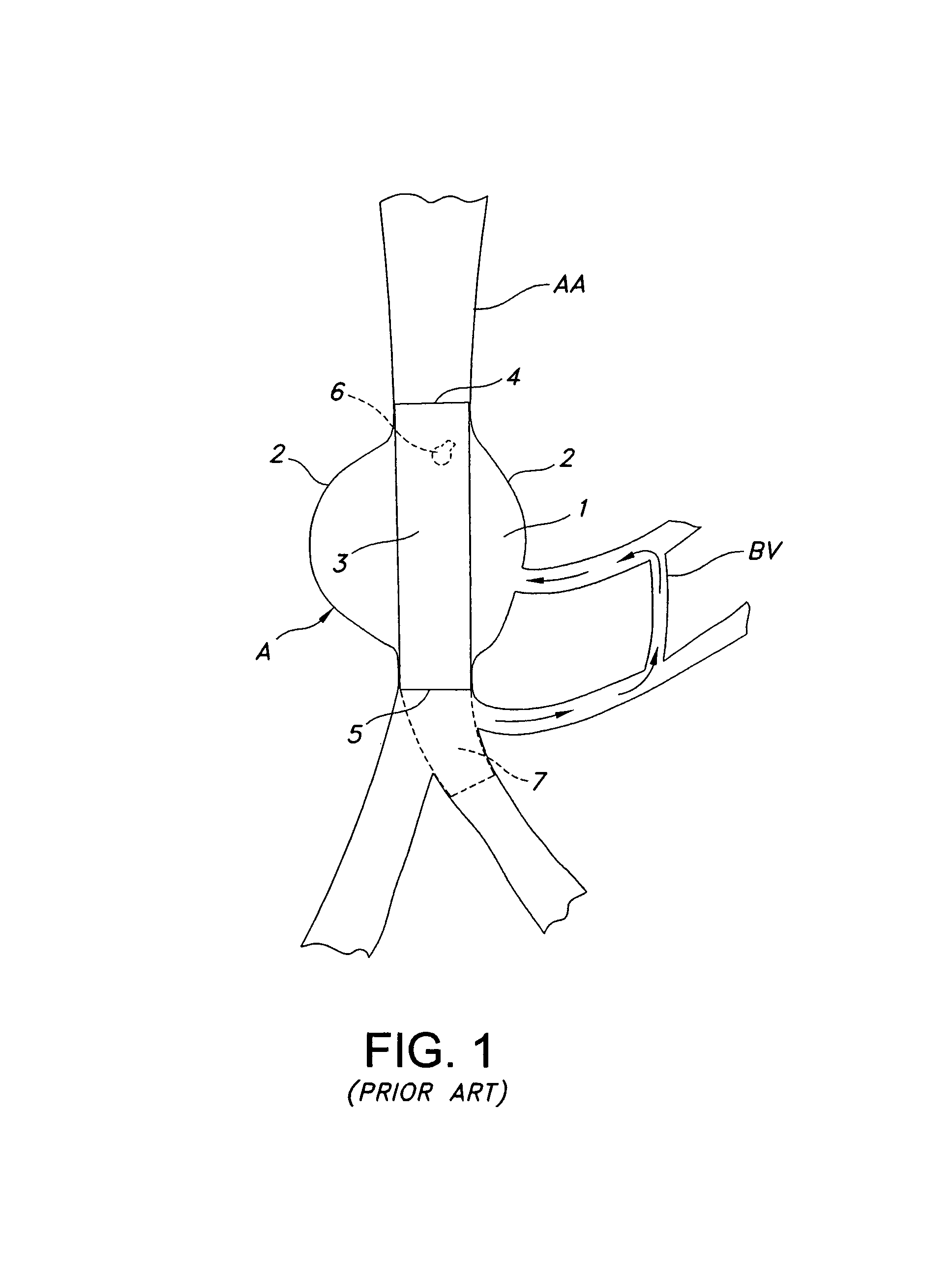 Tubular prosthesis for external agent delivery