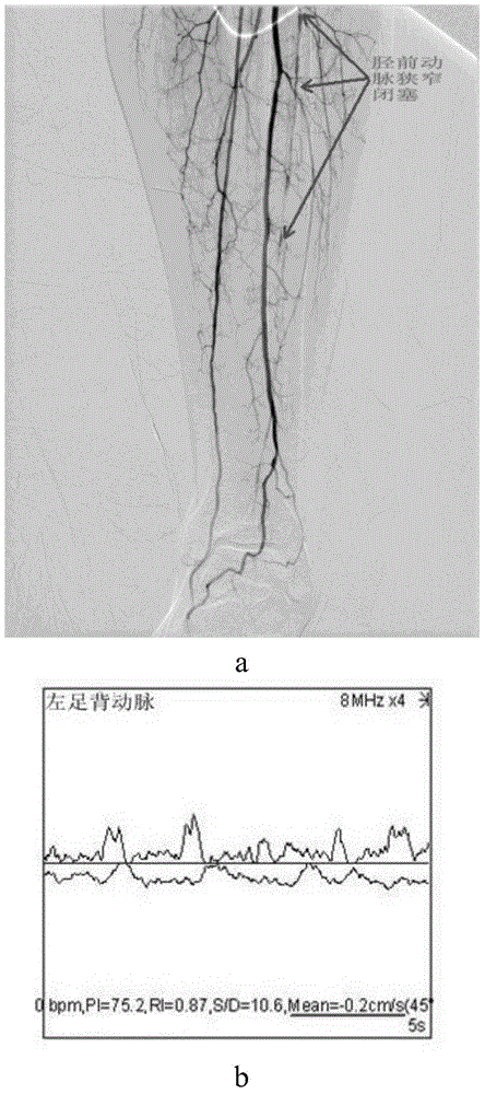 Use of CD133&lt;+&gt; endothelial precursor cells