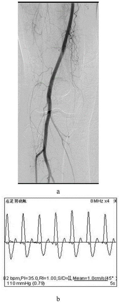 Use of CD133&lt;+&gt; endothelial precursor cells