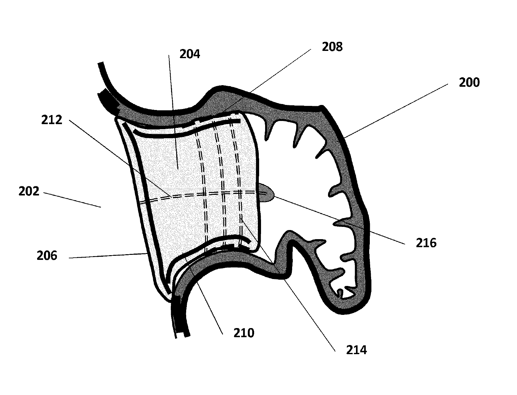 Devices and methods for excluding the left atrial appendage