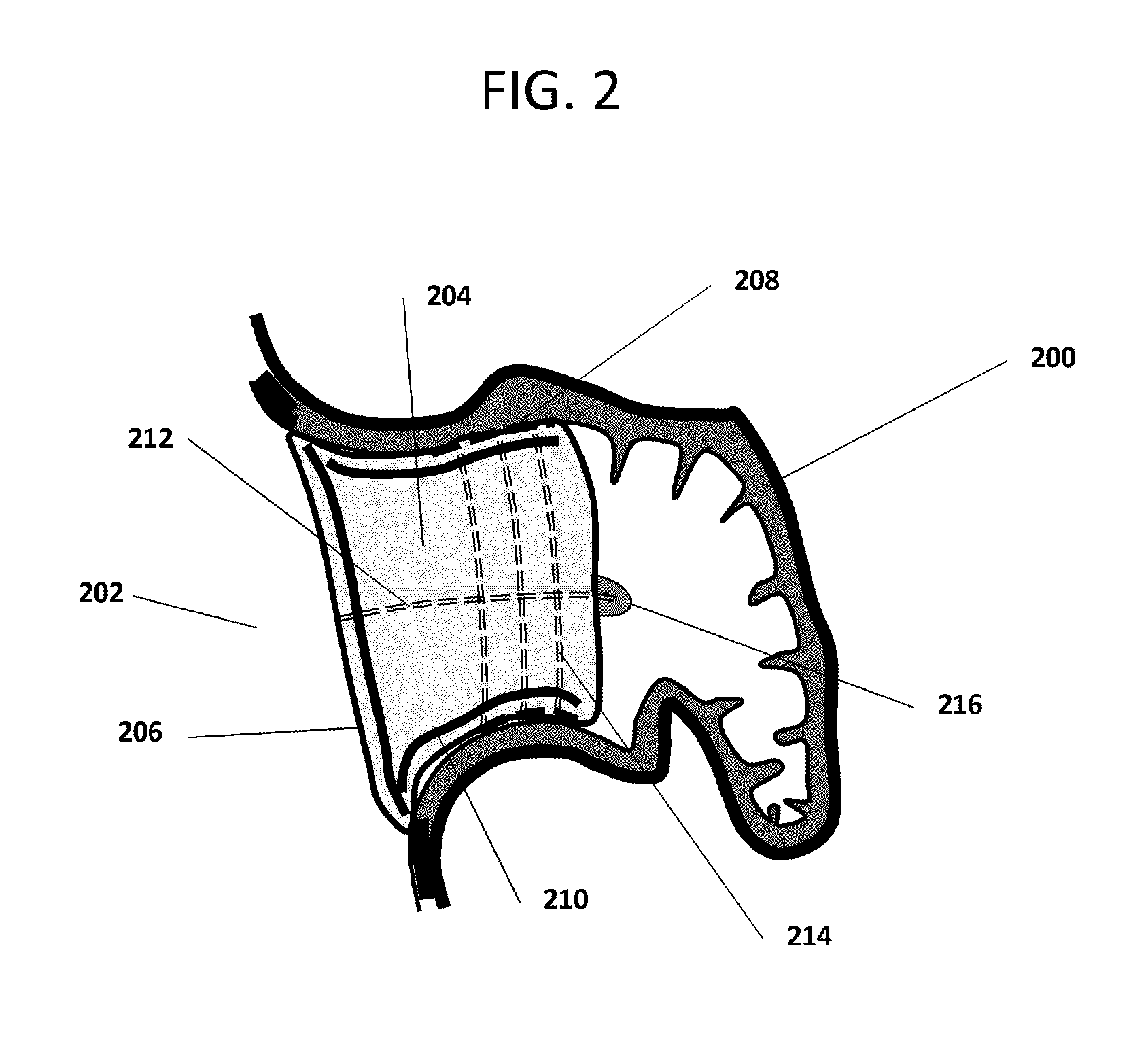 Devices and methods for excluding the left atrial appendage