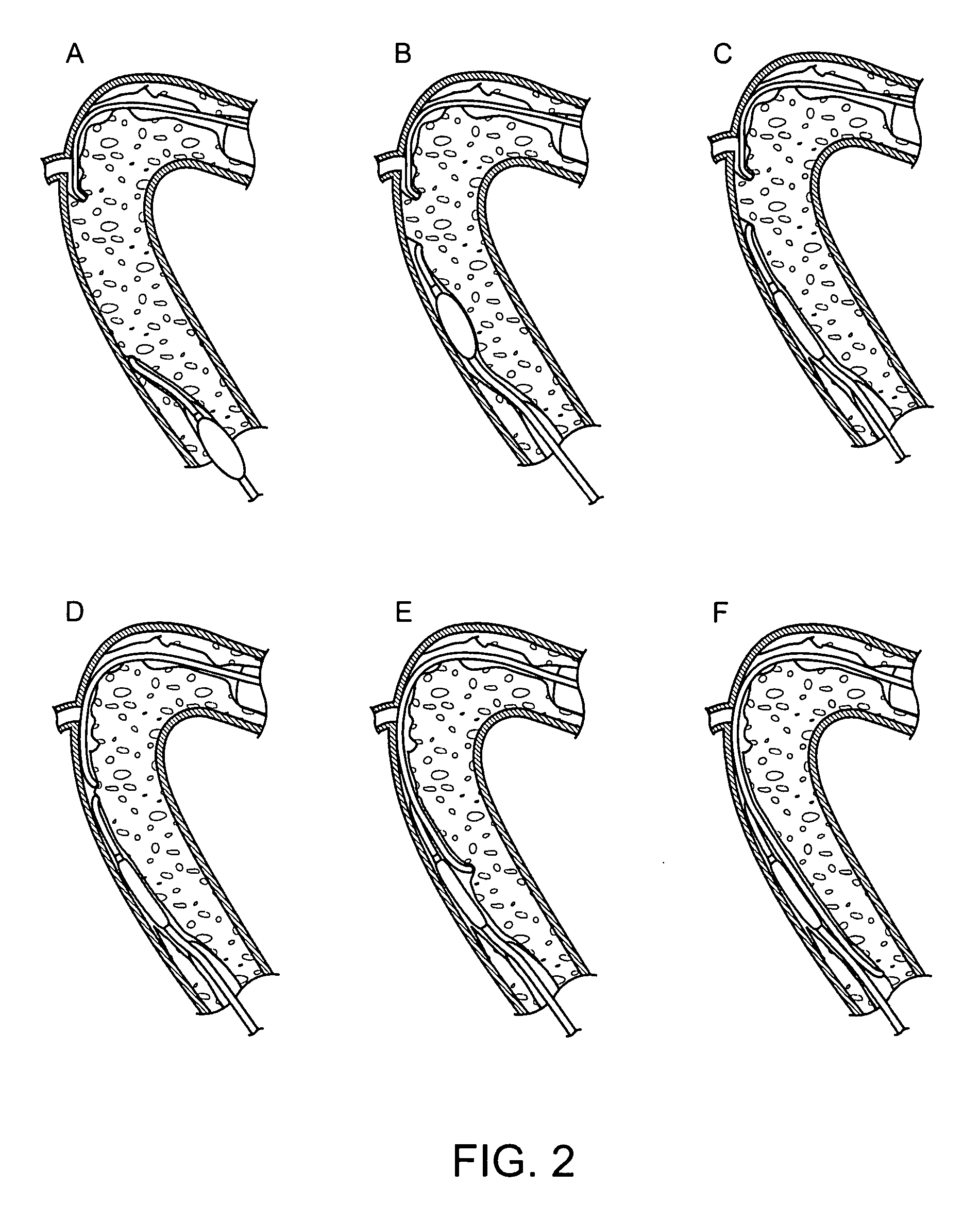 Recanalizing occluded vessels using controlled antegrade and retrograde tracking