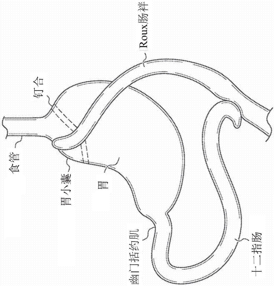 Device allowing pyloric sphincter to normally function for bariatric stents