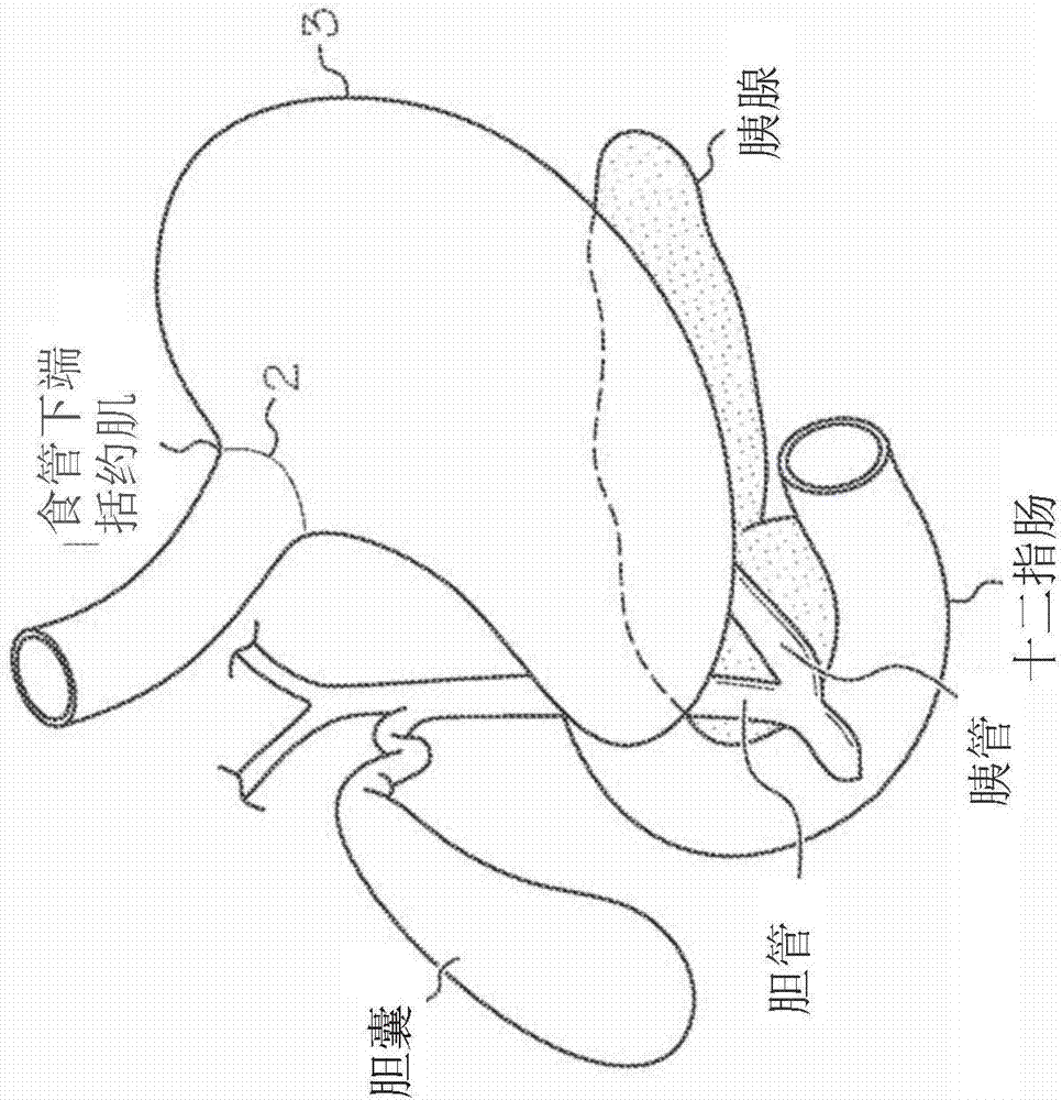 Device allowing pyloric sphincter to normally function for bariatric stents