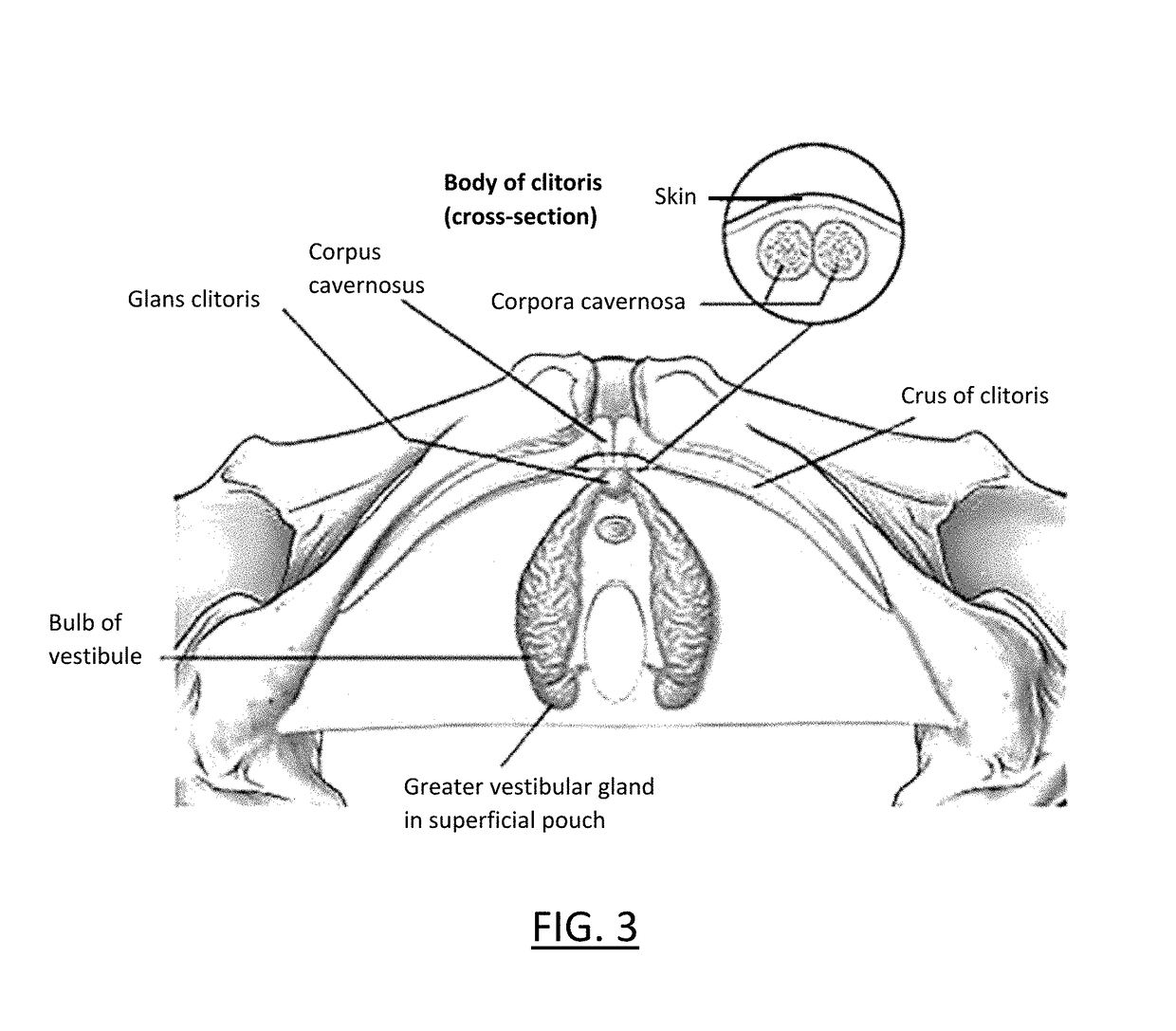 Therapeutic angiogenesis for treating erectile conditions