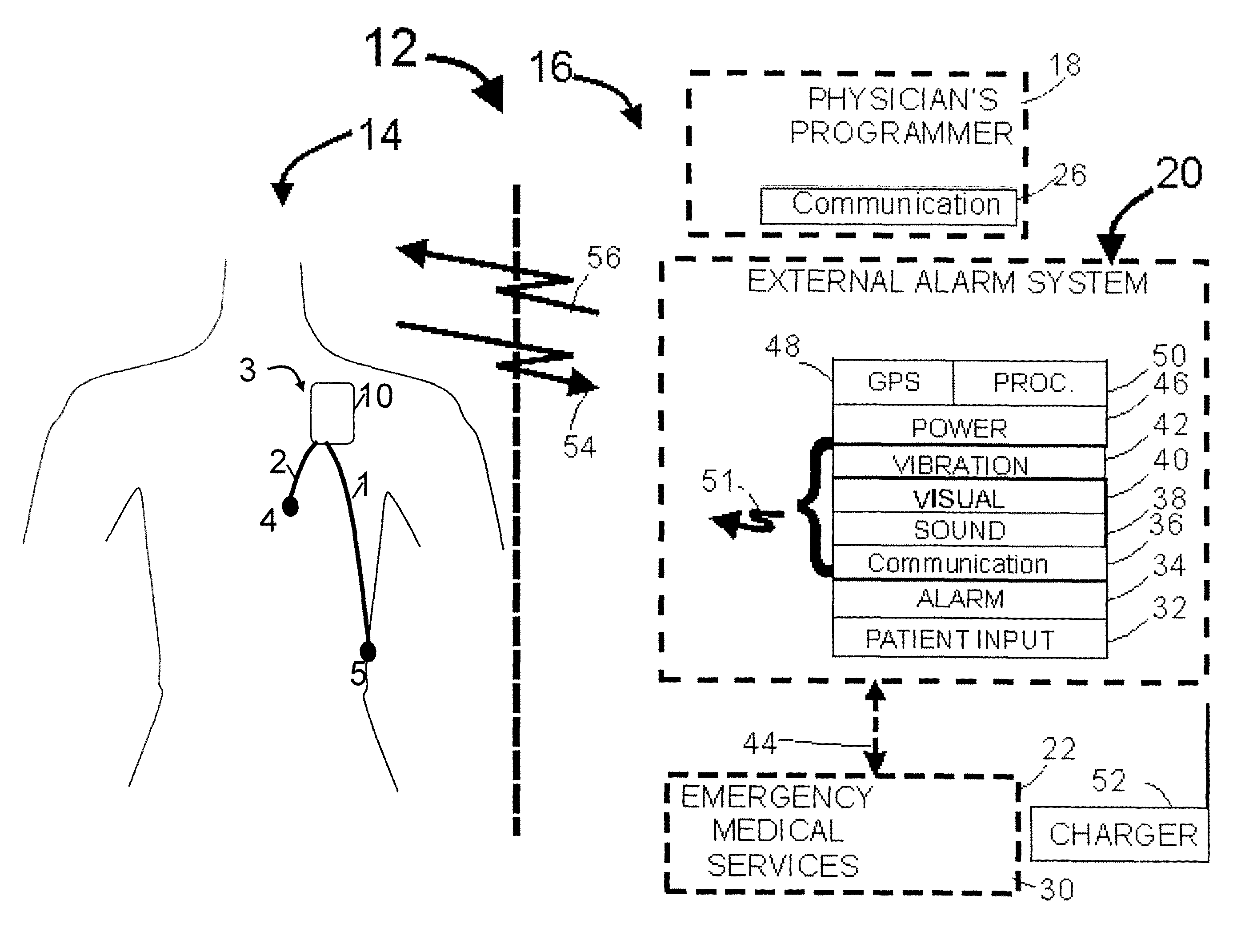 Ischemia detection based on combination of parameters associated with different sensors