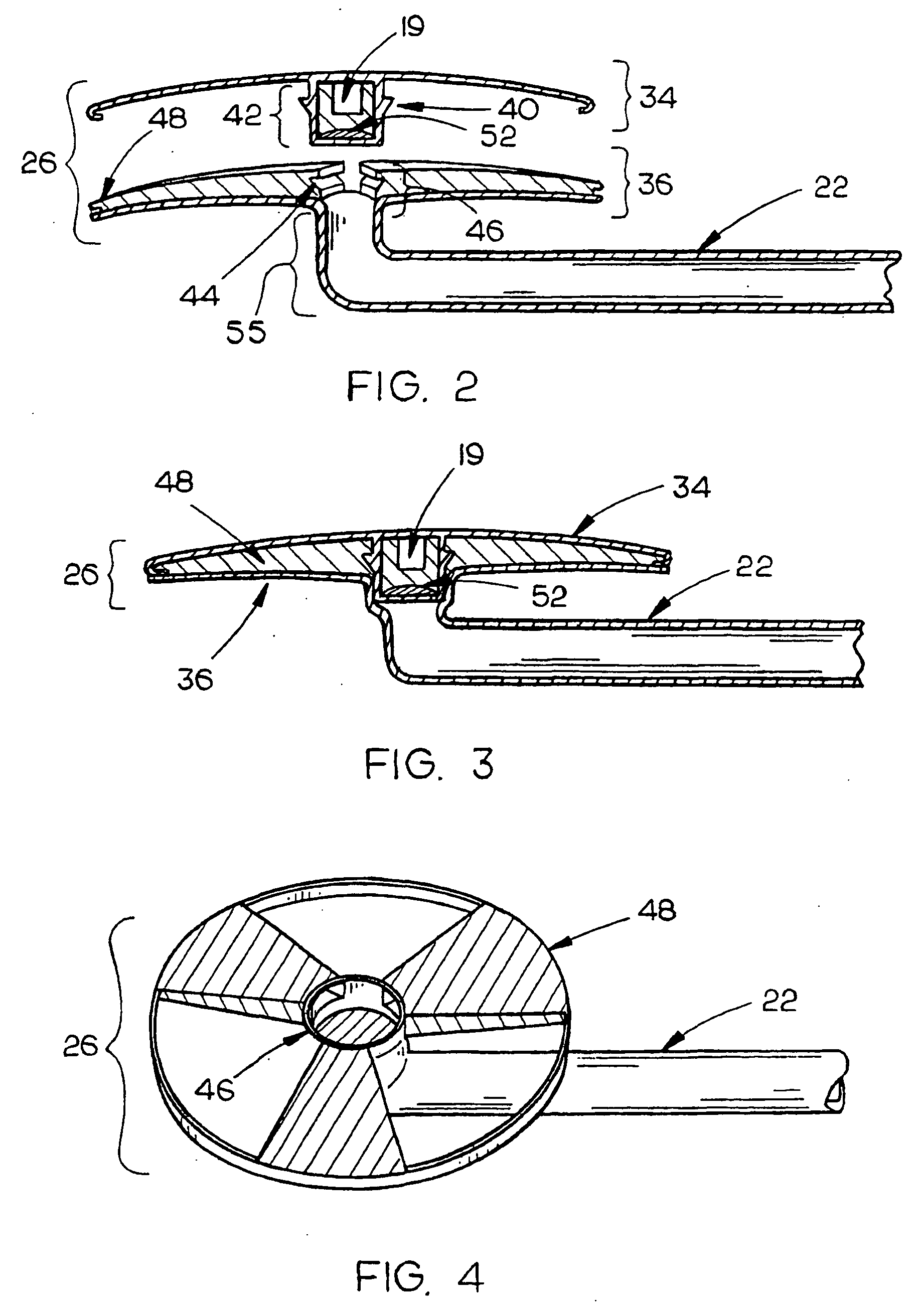 Method and apparatus for reducing intraocular pressure