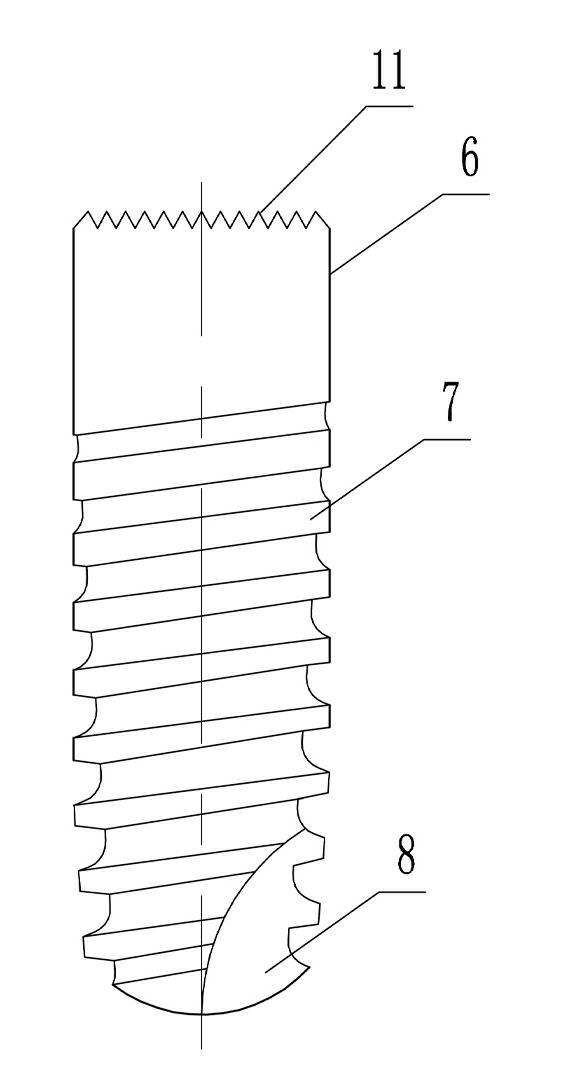 Assembled dental implant