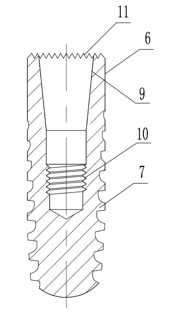 Assembled dental implant