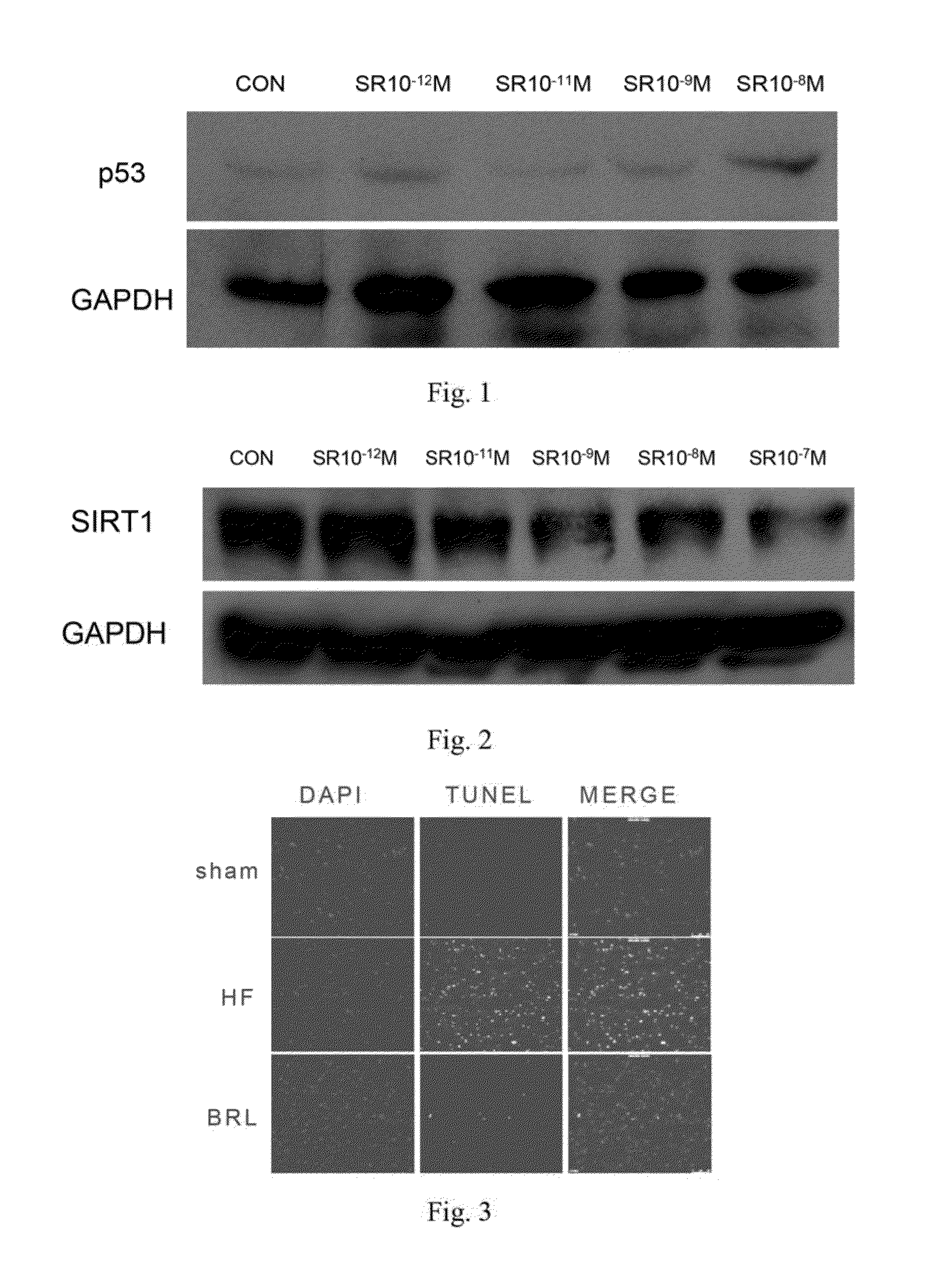 Use of adrenergic beta-e-receptor blockers in cancer treatment