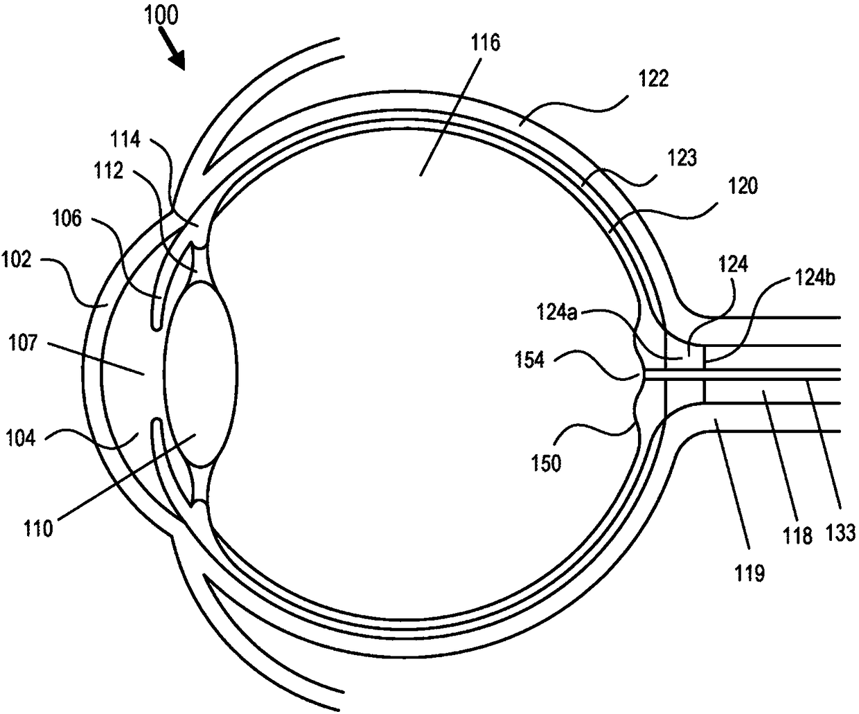 Eye-related intrabody pressure identification and modification