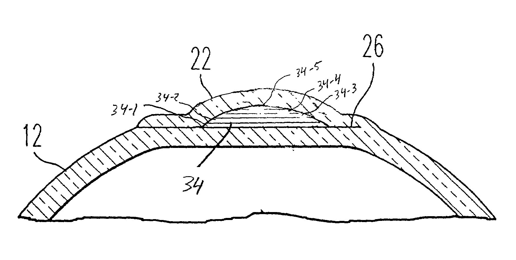 Adjustable universal implant blank for modifying corneal curvature and methods of modifying corneal curvature therewith