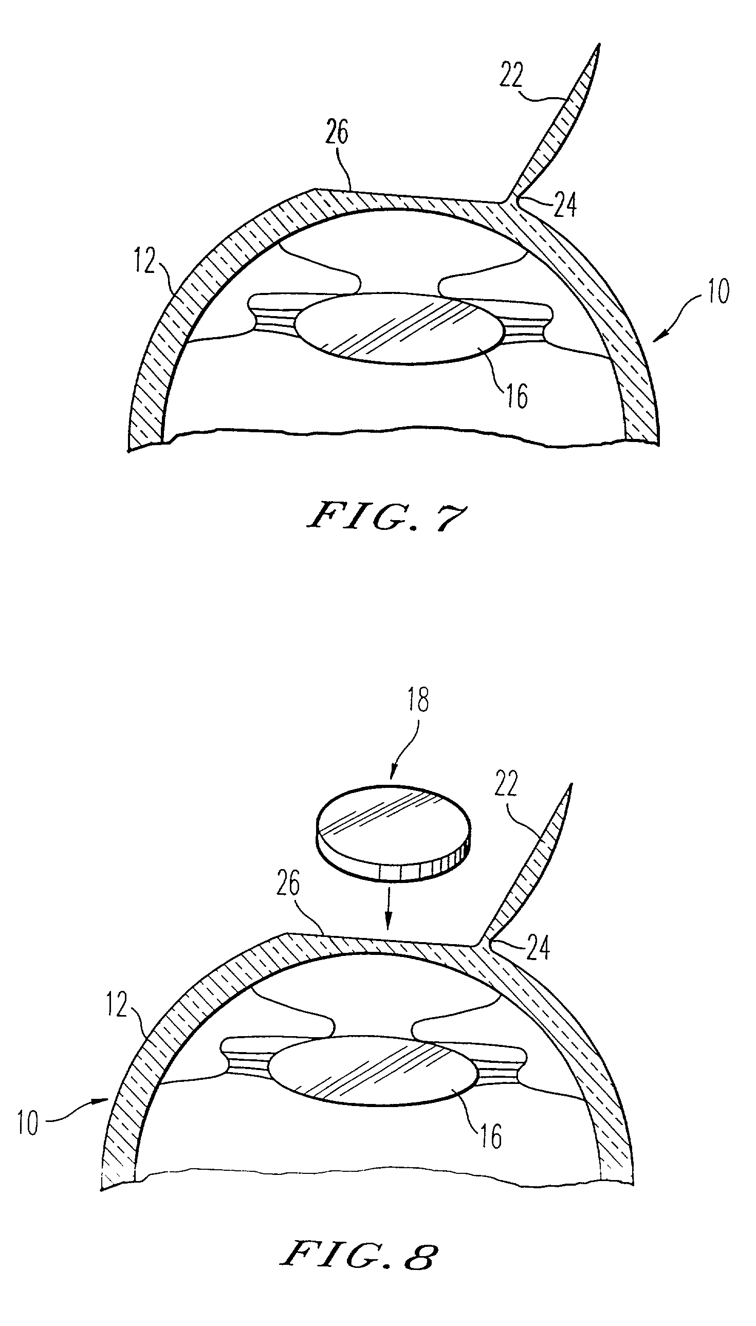 Adjustable universal implant blank for modifying corneal curvature and methods of modifying corneal curvature therewith