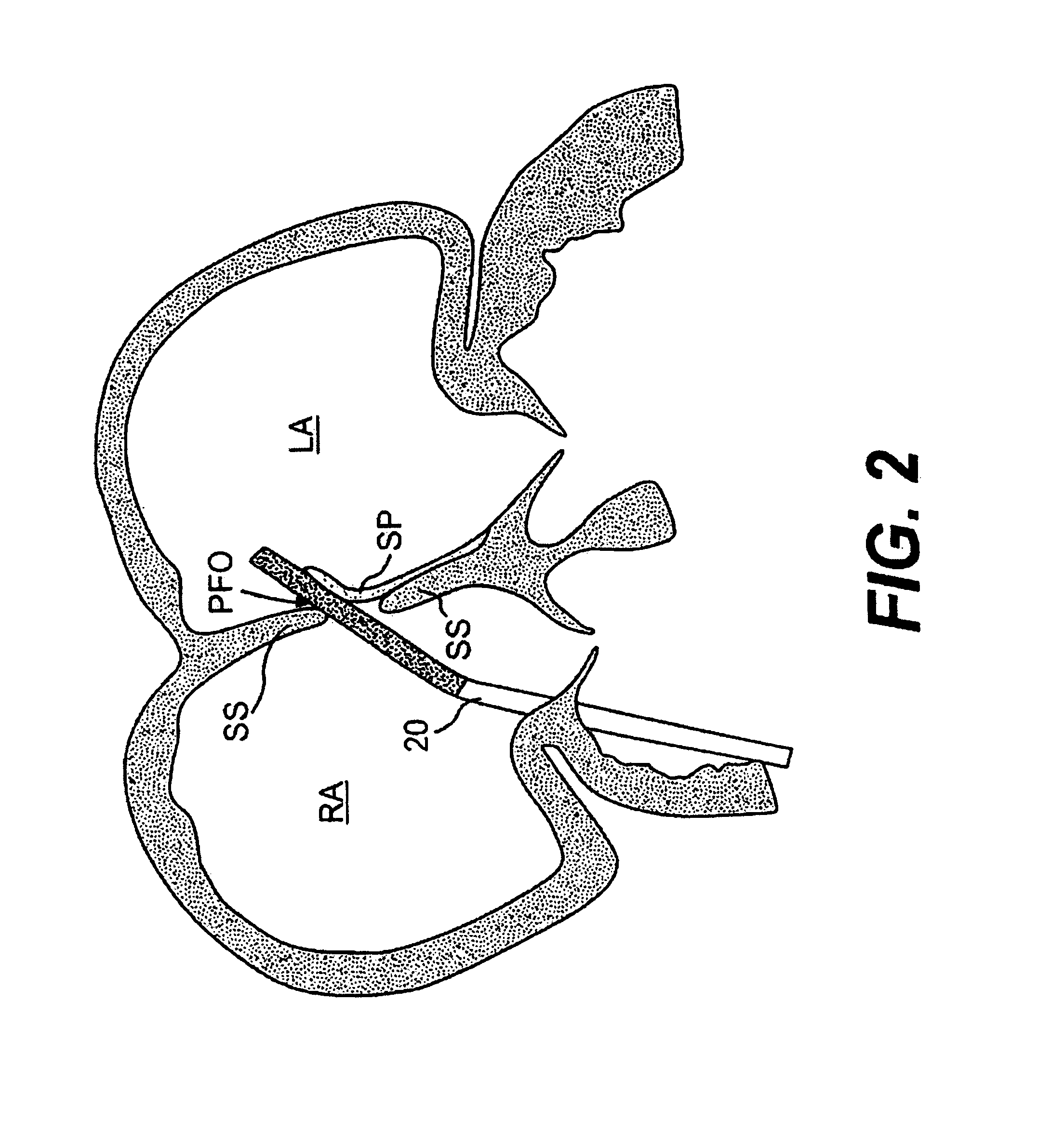 Closure devices, related delivery methods and tools, and related methods of use