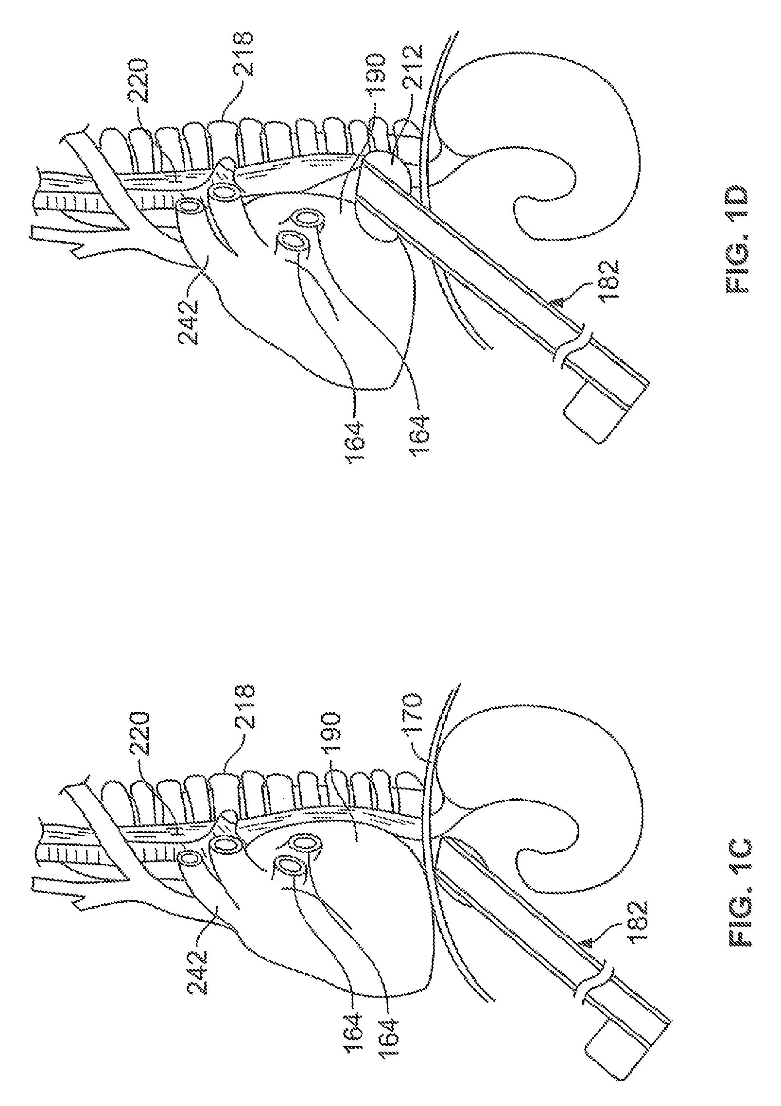 Diaphragm entry for posterior surgical access