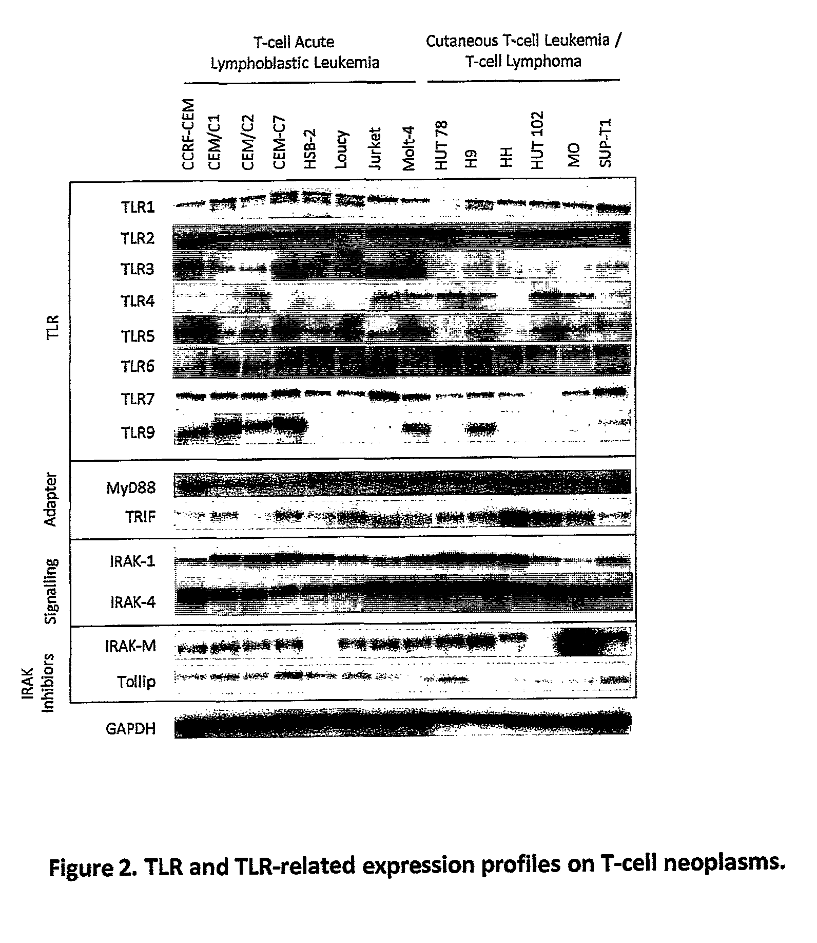 Total and phosphorylated IL-1 receptor-associated kinase-1 and IL-1 receptor-associated kinase-4 as a biomarker for cancer progression and chemotherapy resistance