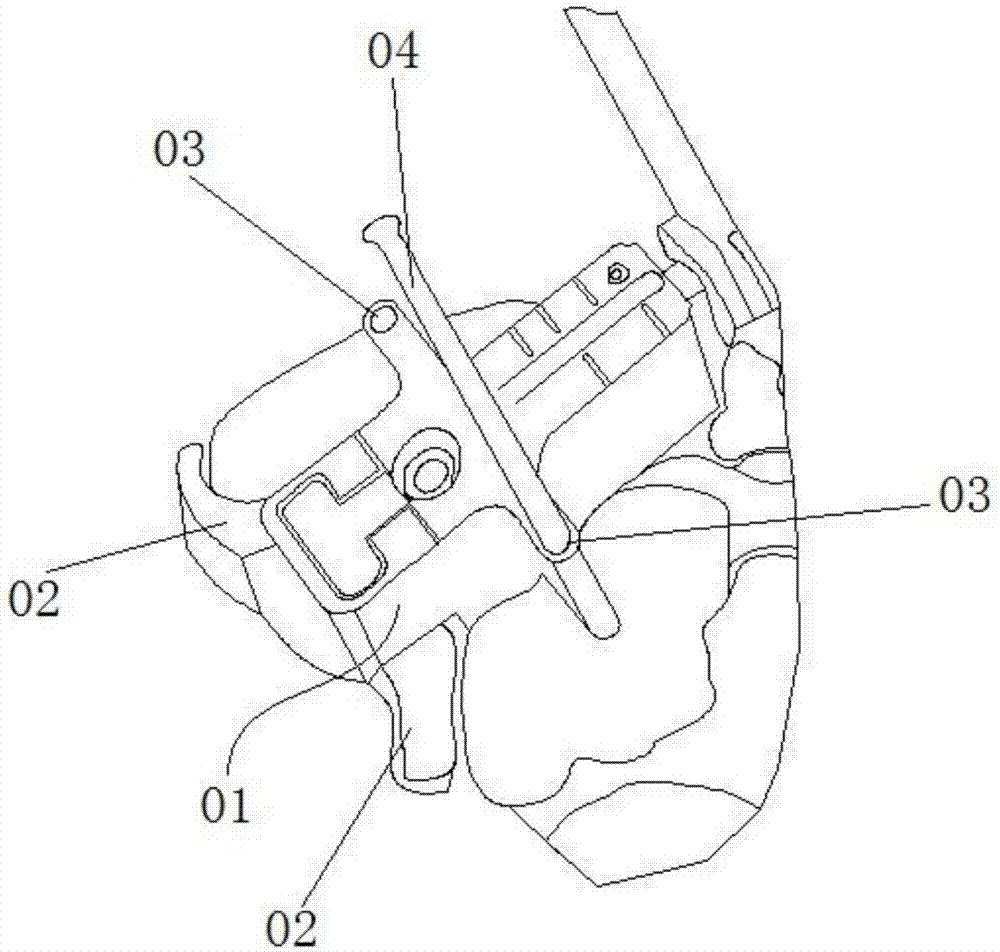 Corrector for joint replacement