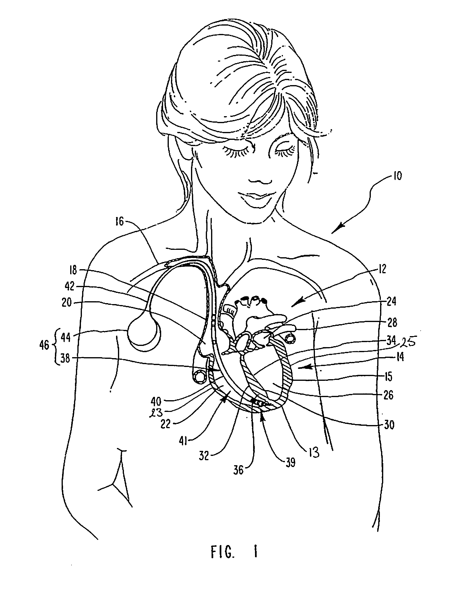 Methods for treating pulmonary hypertension and compositions comprising vasoactive intestinal peptide