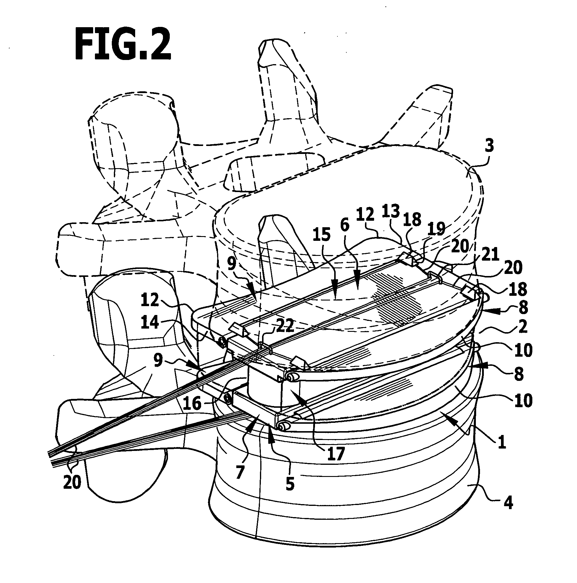 Intervertebral implant