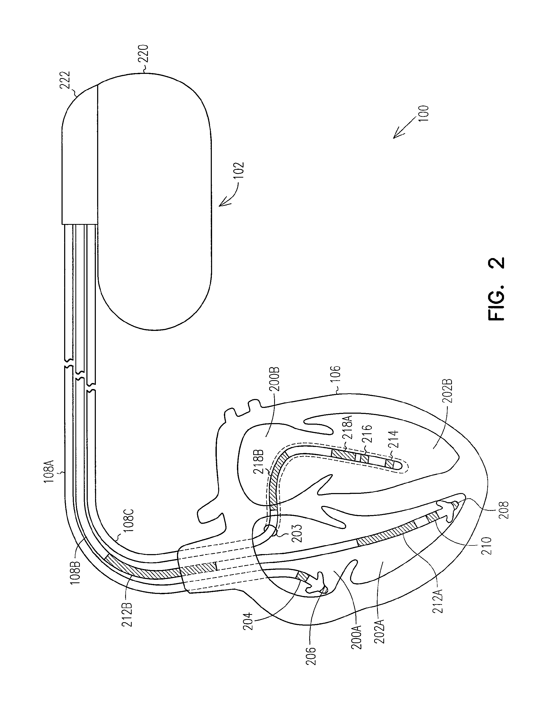 Prediction of thoracic fluid accumulation