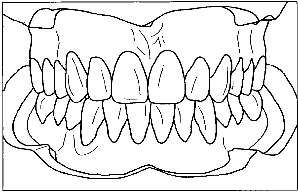 Tooth replacement