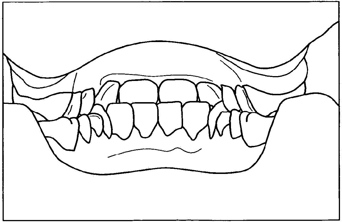 Tooth replacement