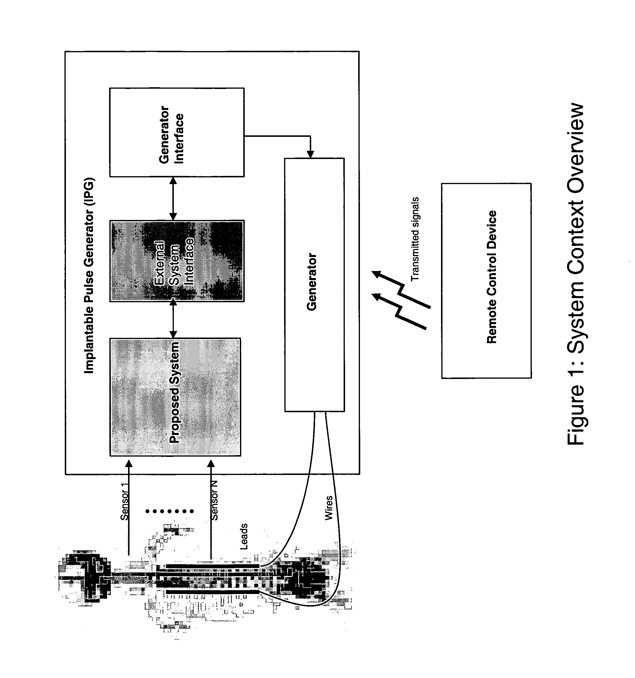 Self-adaptive system for the automatic detection of discomfort and the automatic generation of SCS therapies for chronic pain control