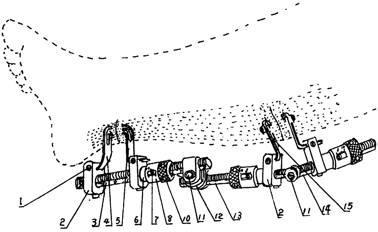 Combined external fixation support for minimally invasive treatment of achilles-tendon-skin multi-section dividing