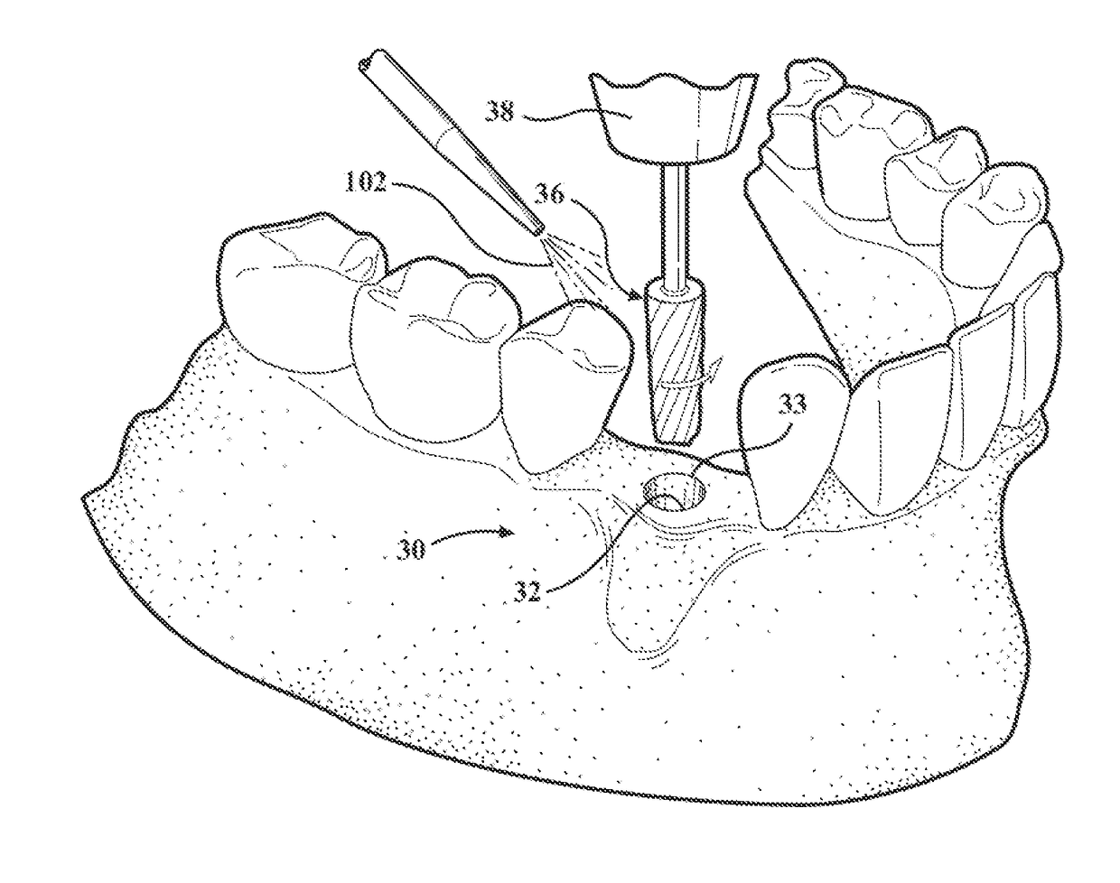 Hydro-mechanical autografting tool and method of use