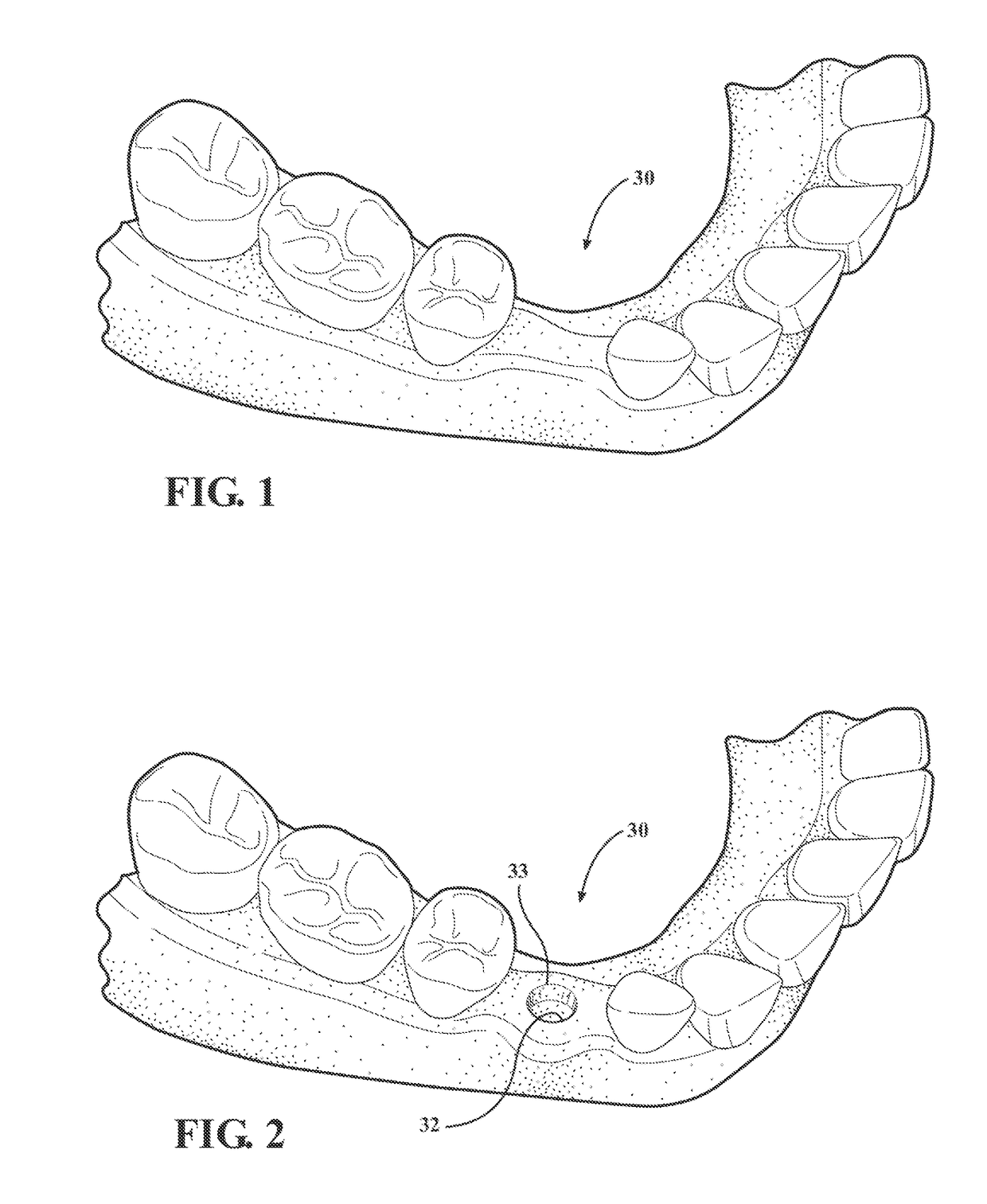 Hydro-mechanical autografting tool and method of use