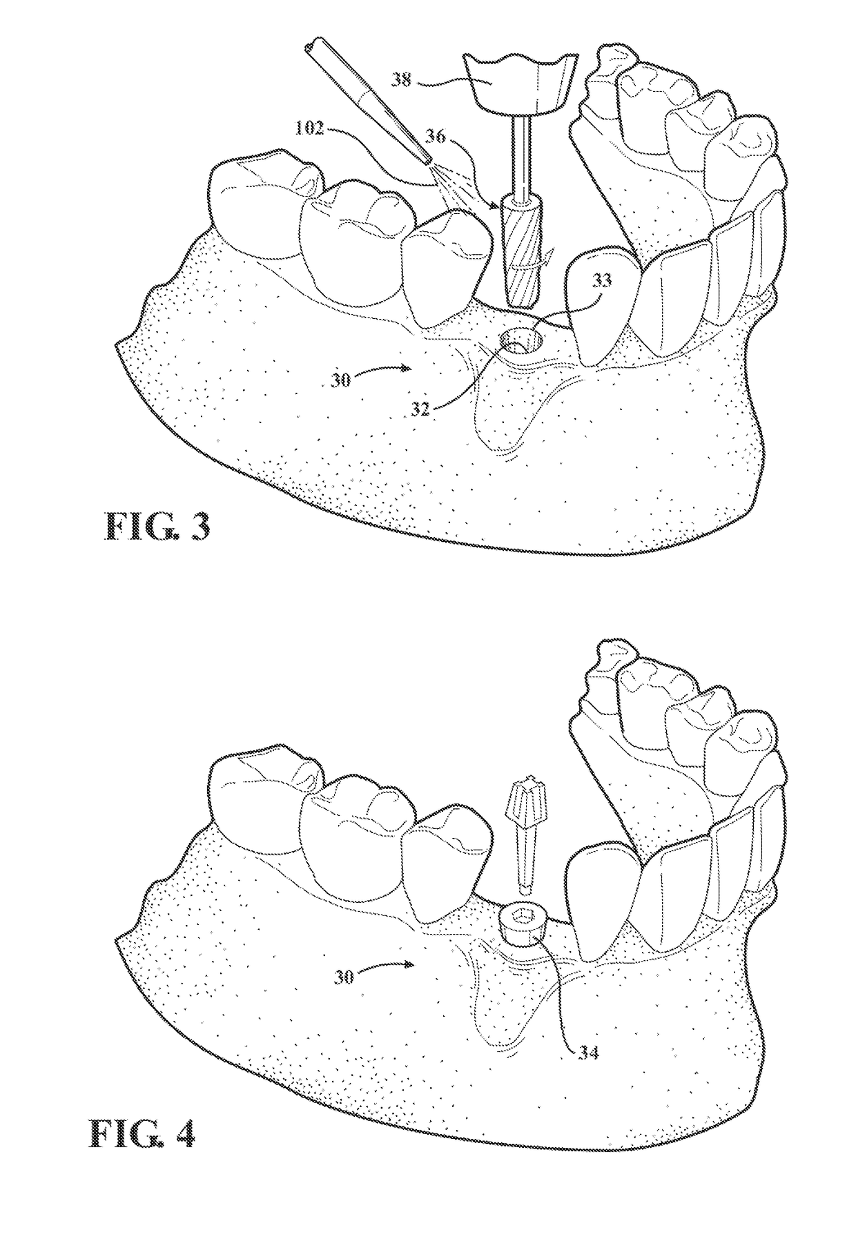 Hydro-mechanical autografting tool and method of use