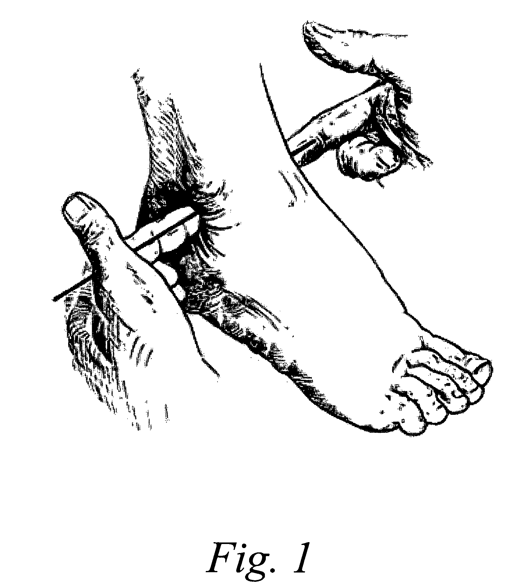 Ankle derotation and subtalar stabilization orthosis