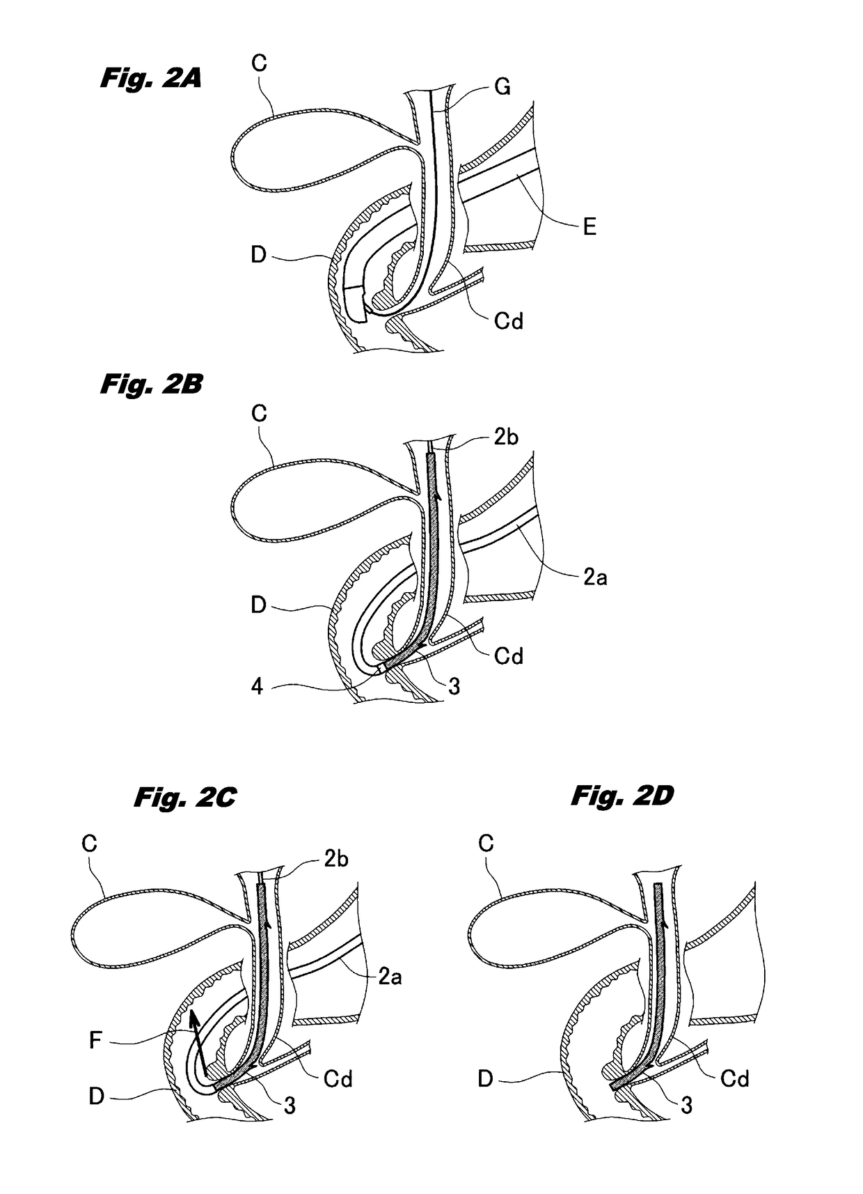 Biliary Tract Drainage Tube