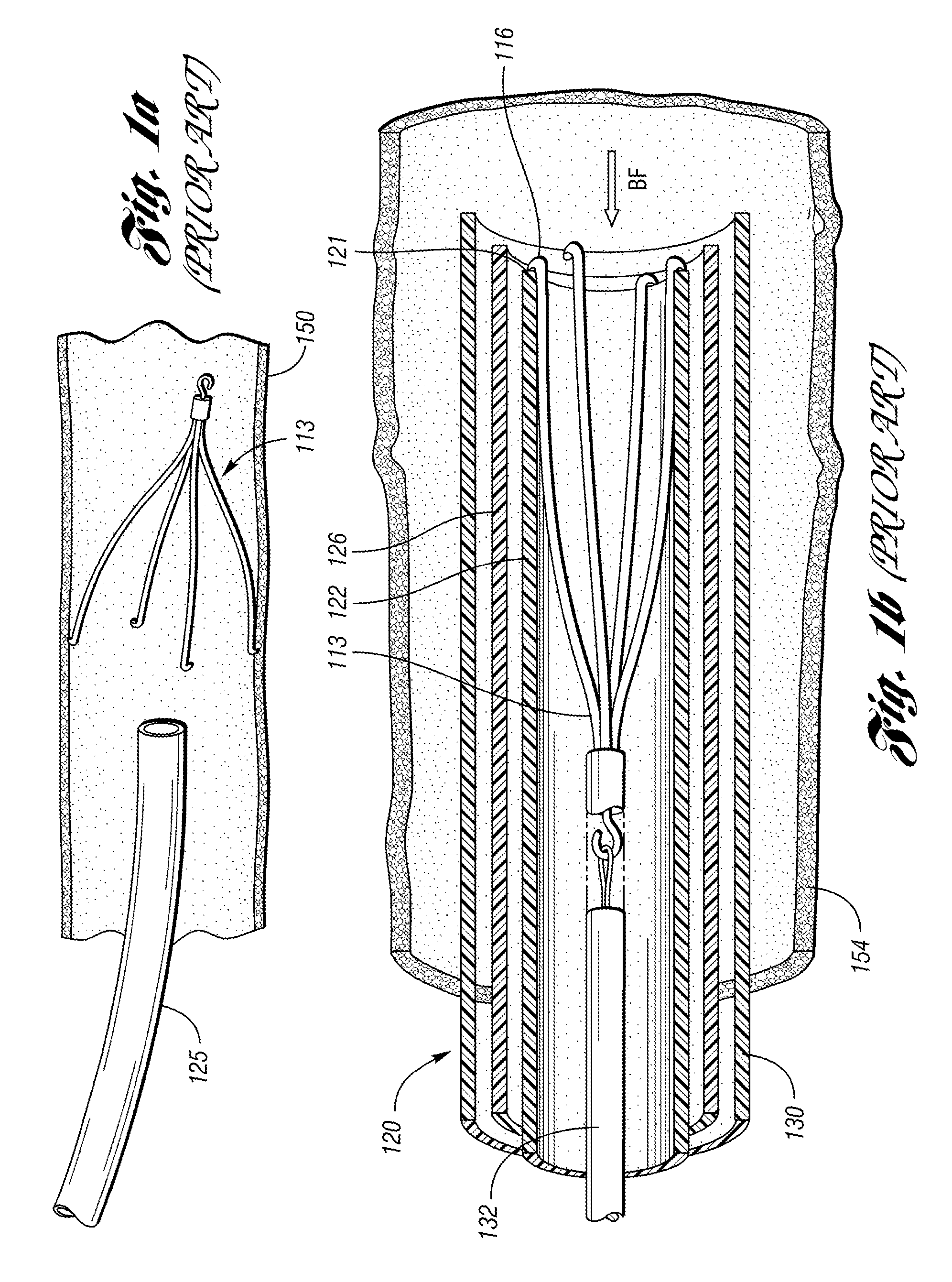 Removable vena cava filter