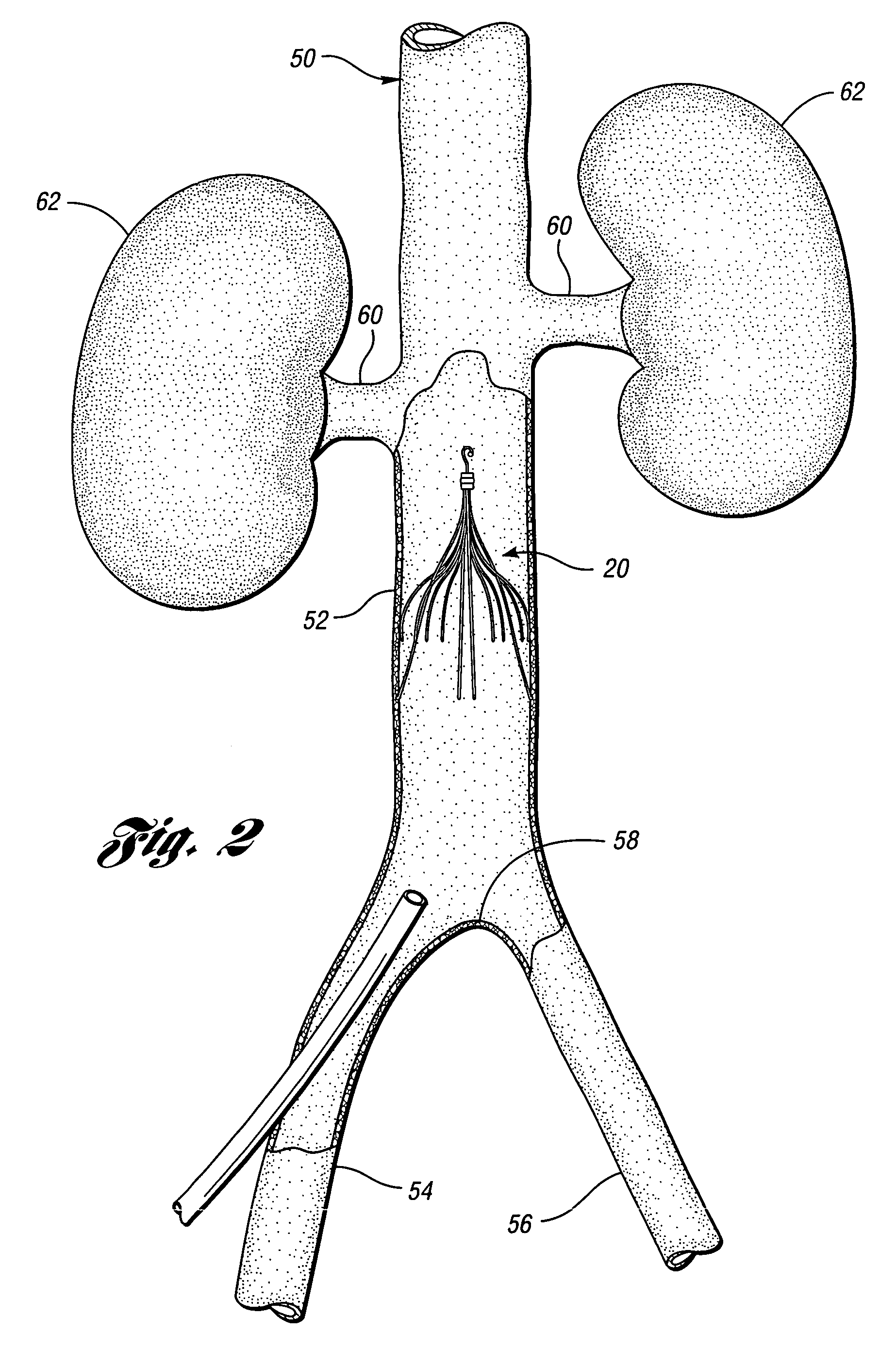 Removable vena cava filter